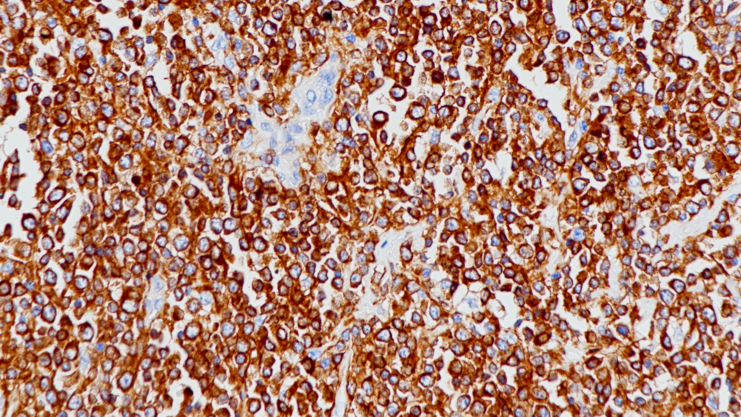 滤泡性淋巴瘤CD79a(BP6040)染色