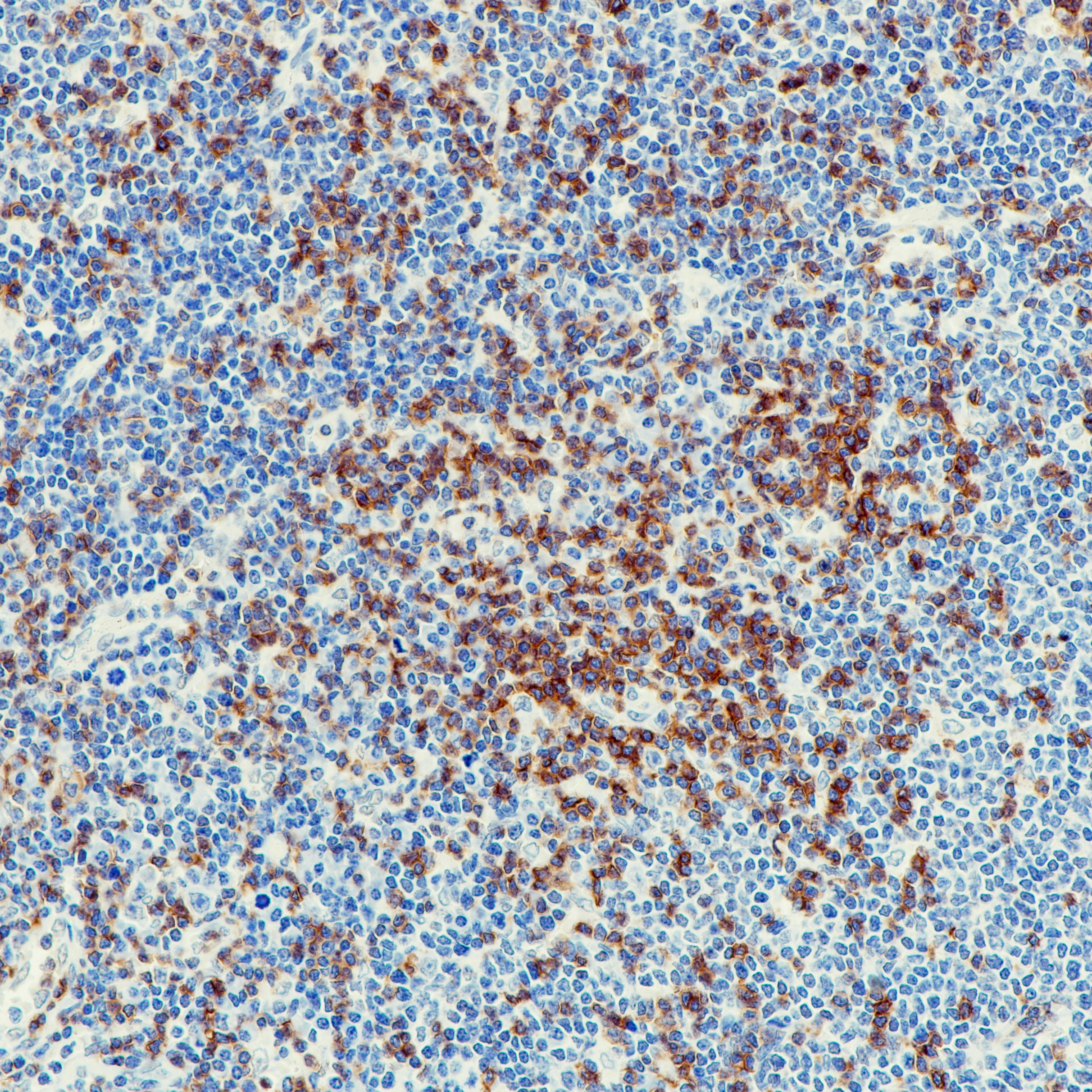 套细胞淋巴瘤CD45R0 (UCHL-1)