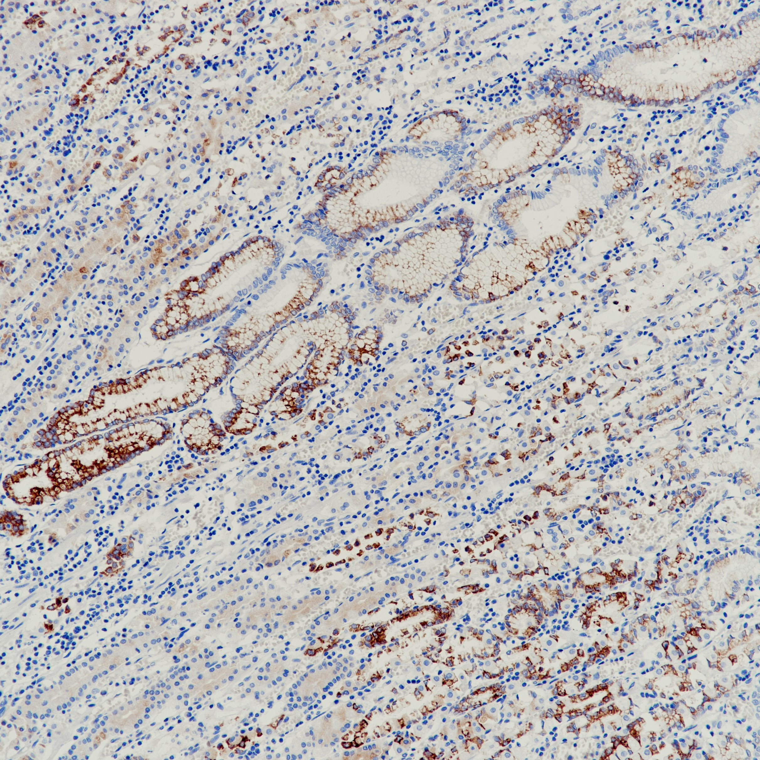 胃癌MUC6(EPR20623)染色