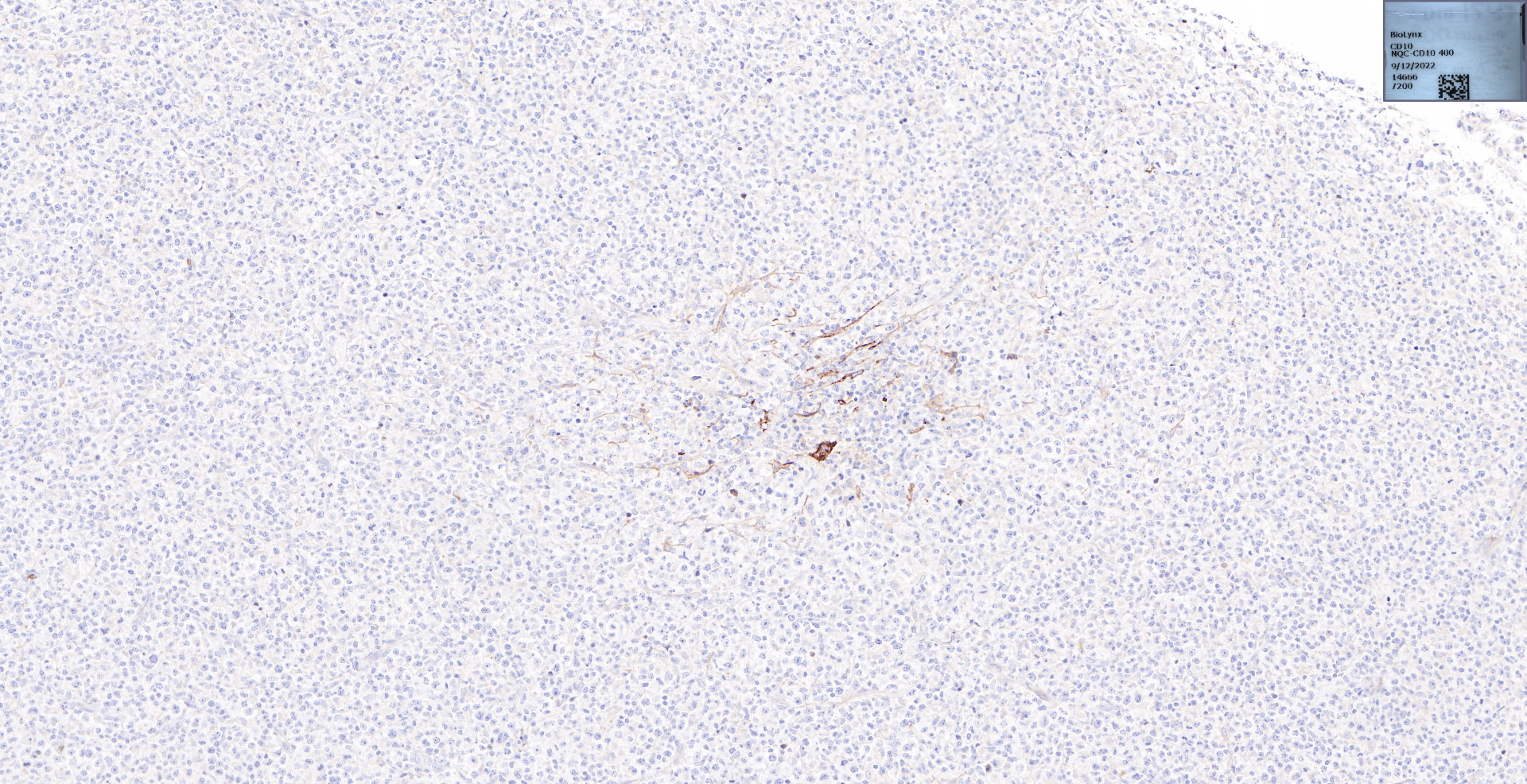弥漫大B细胞淋巴瘤（non-GCB）.jpg