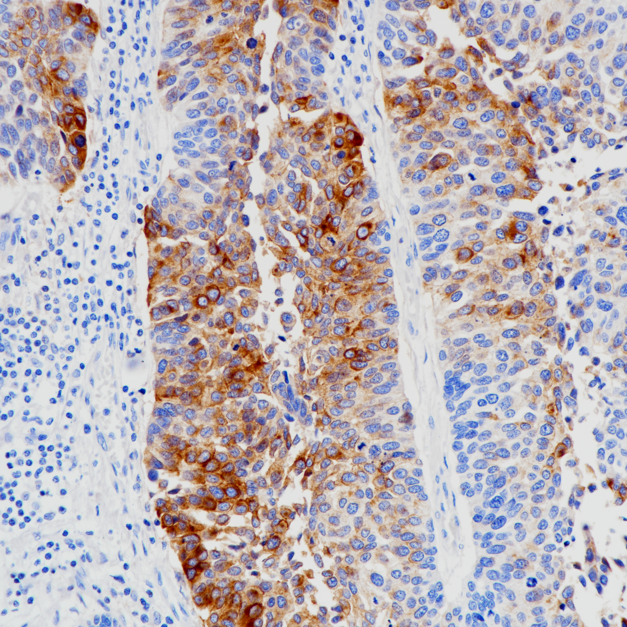 膀胱癌uroplakin III（BP6199）染色