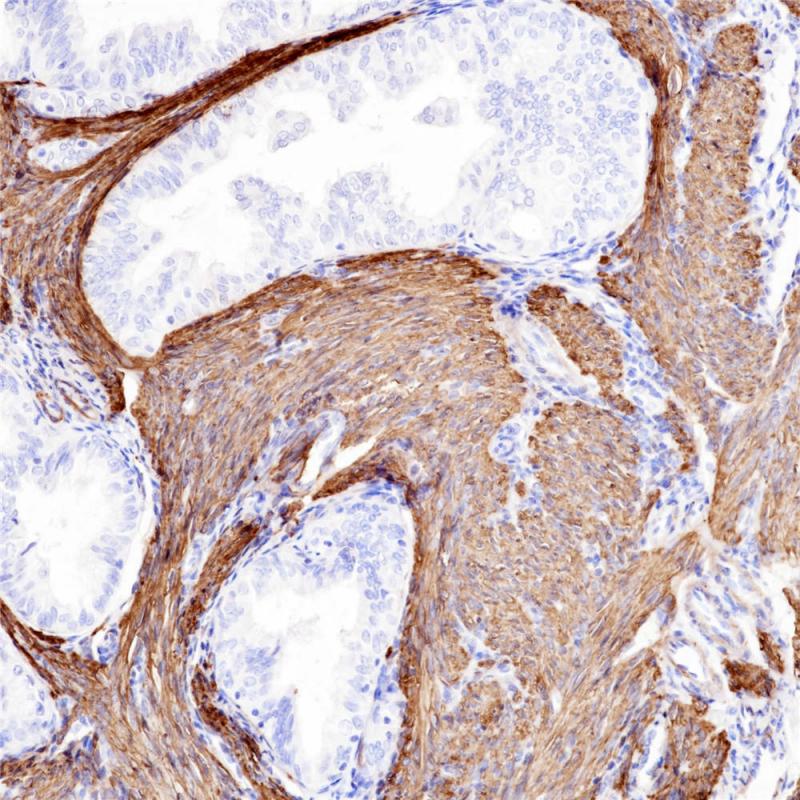 子宫内膜癌Calponin(BP6093)染色