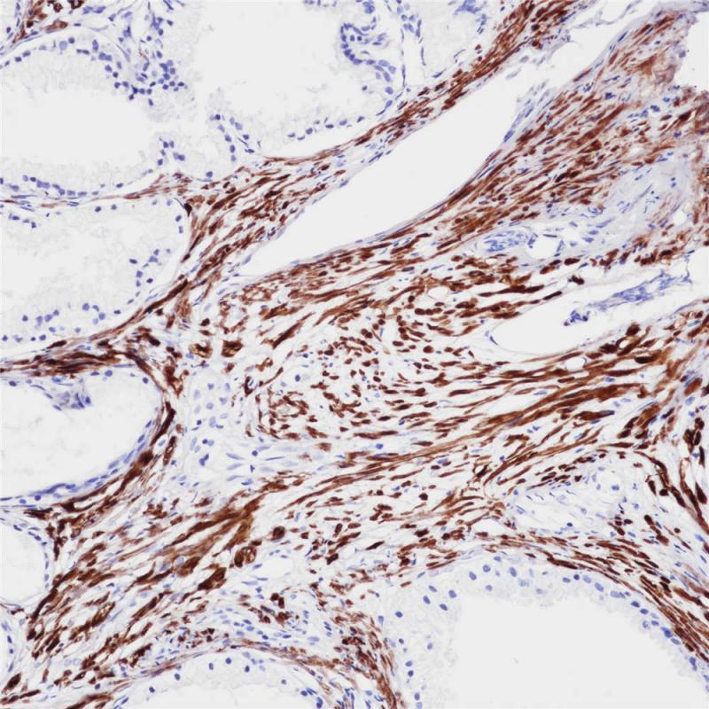 前列腺癌Calponin(BP6093)染色