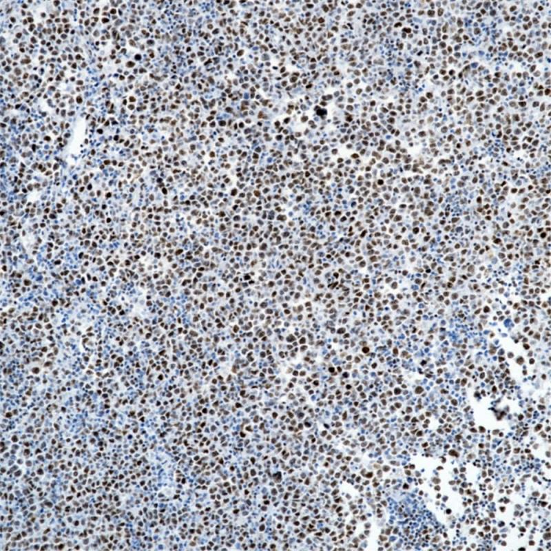 弥漫性大B细胞淋巴瘤 FOXP1 (BP6112) 染色
