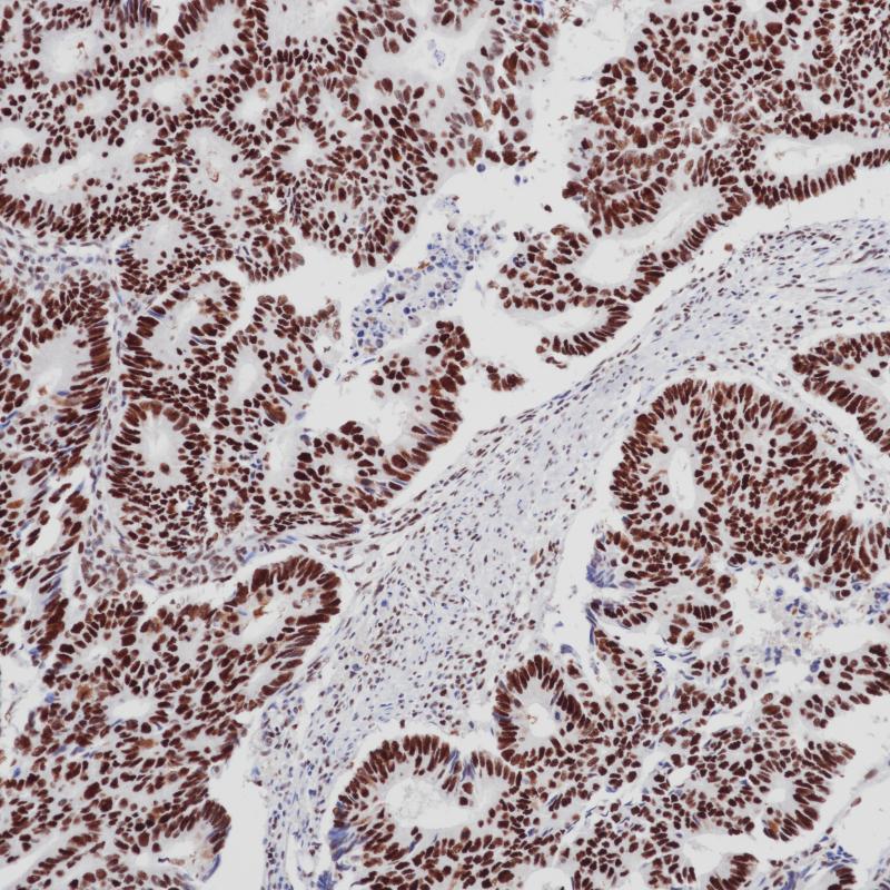 结肠癌 MSH2（BPM6143）染色