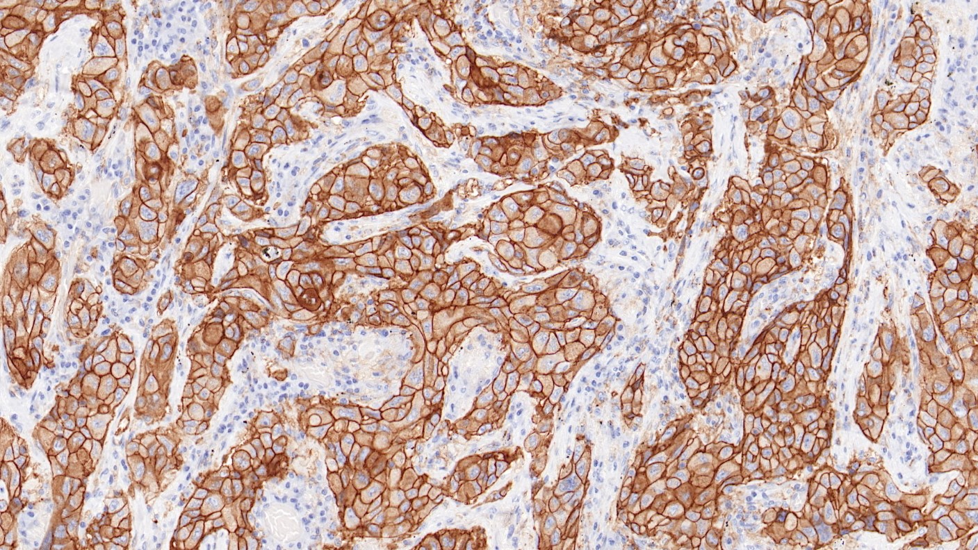 非小细胞肺癌PD-L1(BP6099)染色