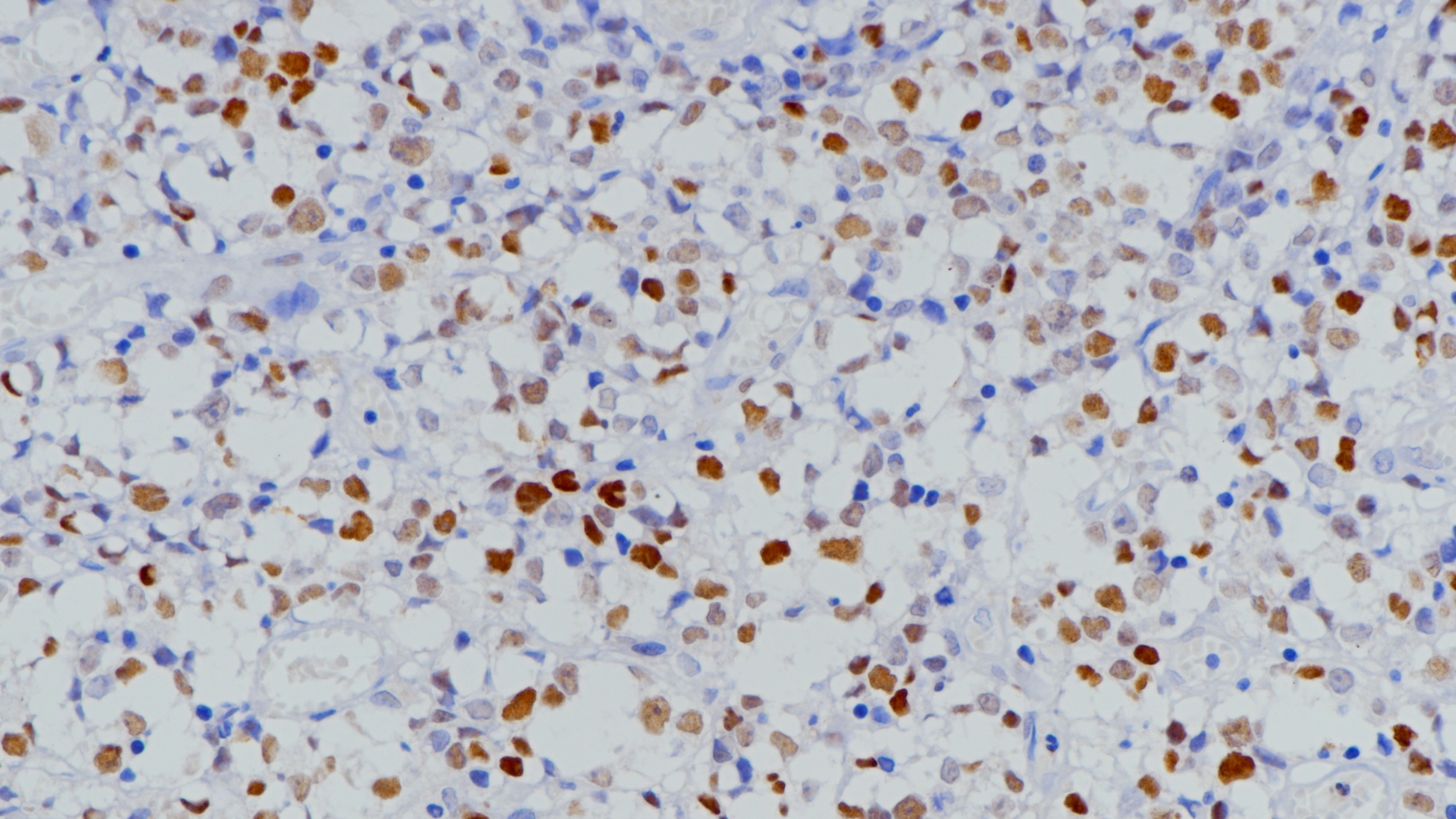 弥漫大B细胞淋巴瘤Bcl-6(BP6191)染色