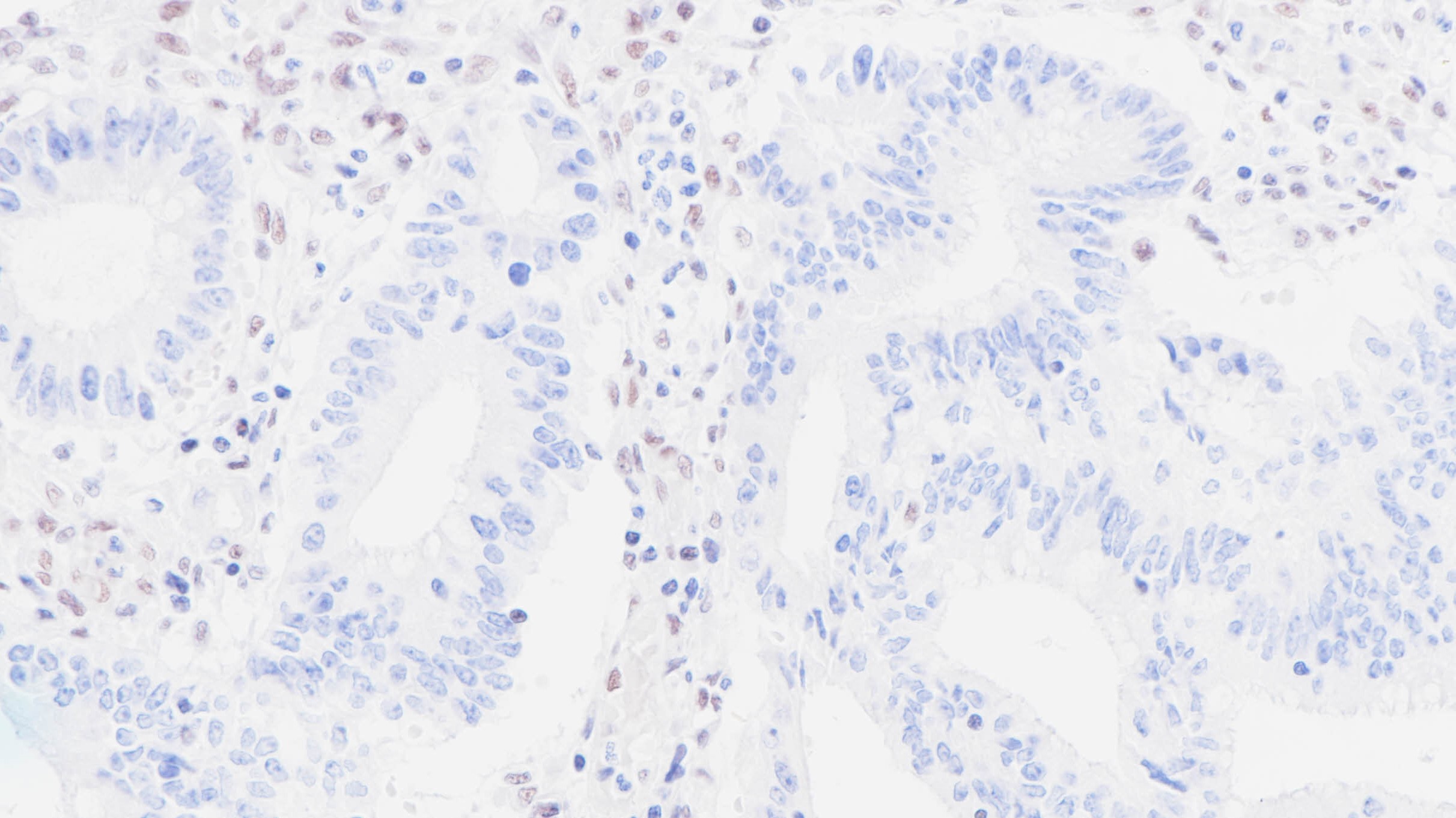 MLH1缺失表达的结肠癌(BPM6179)染色
