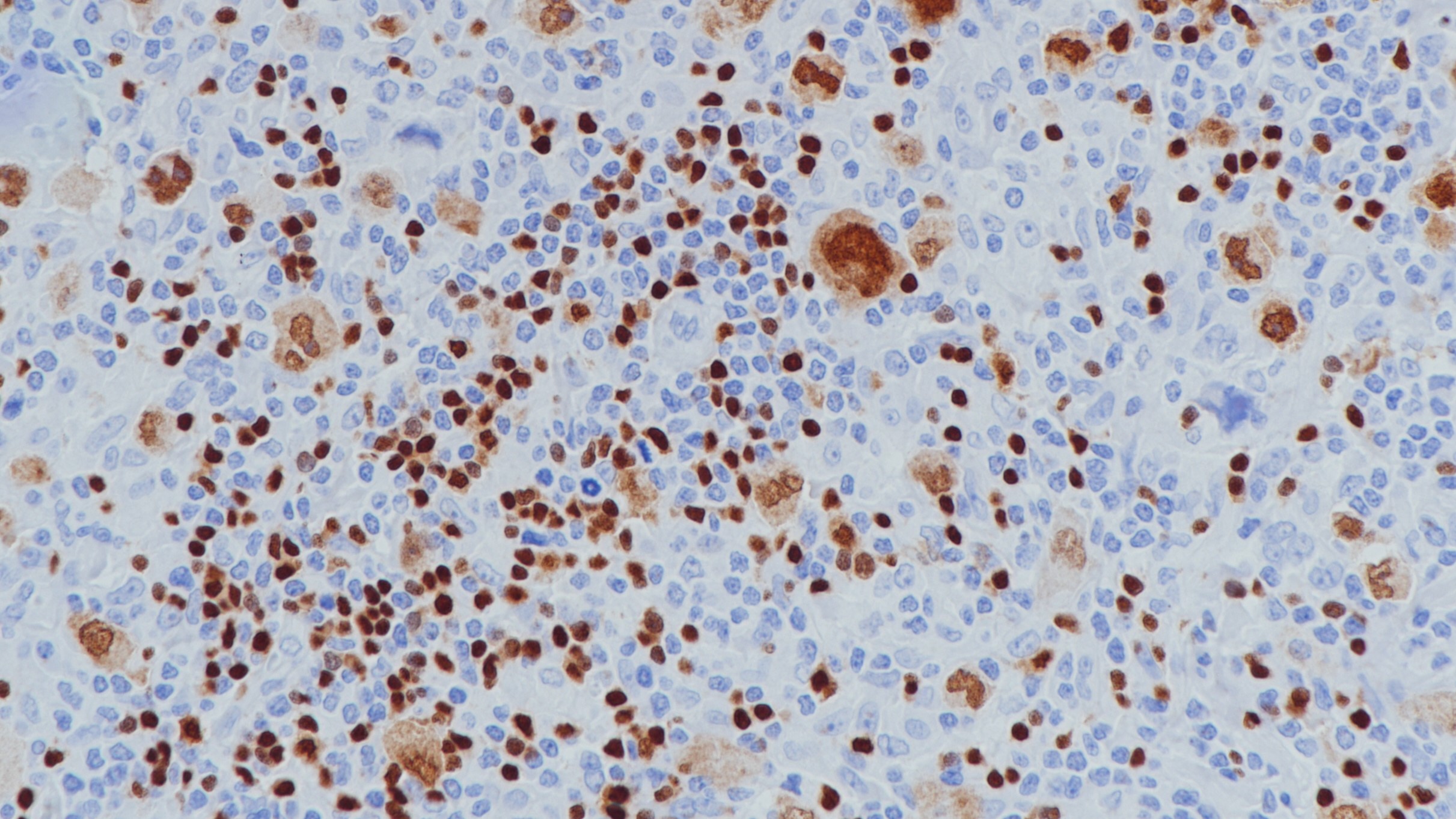 霍奇金淋巴瘤Pax-5(BPM6172)染色