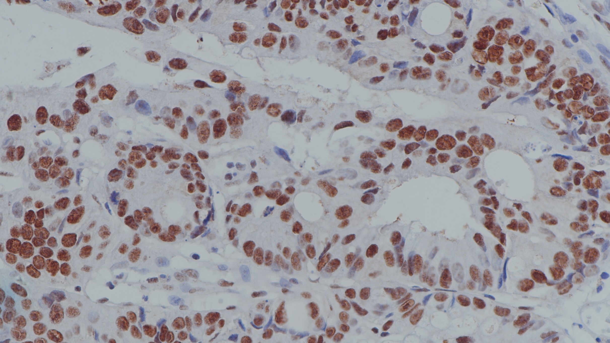 结肠癌MLH1(BPM6179)染色