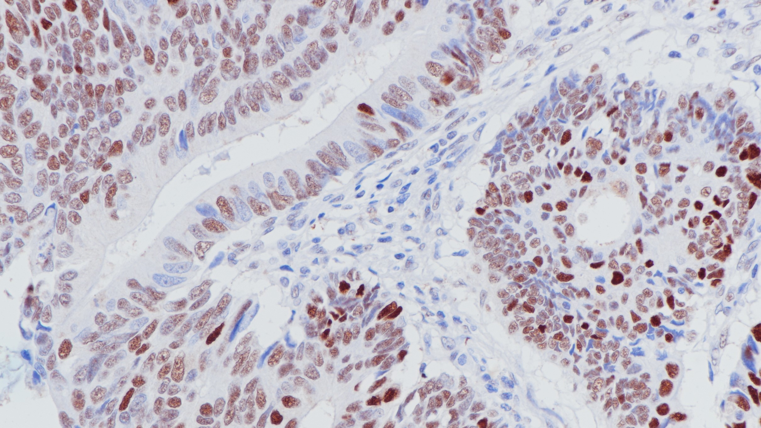 结肠癌p53(BPM6168)染色
