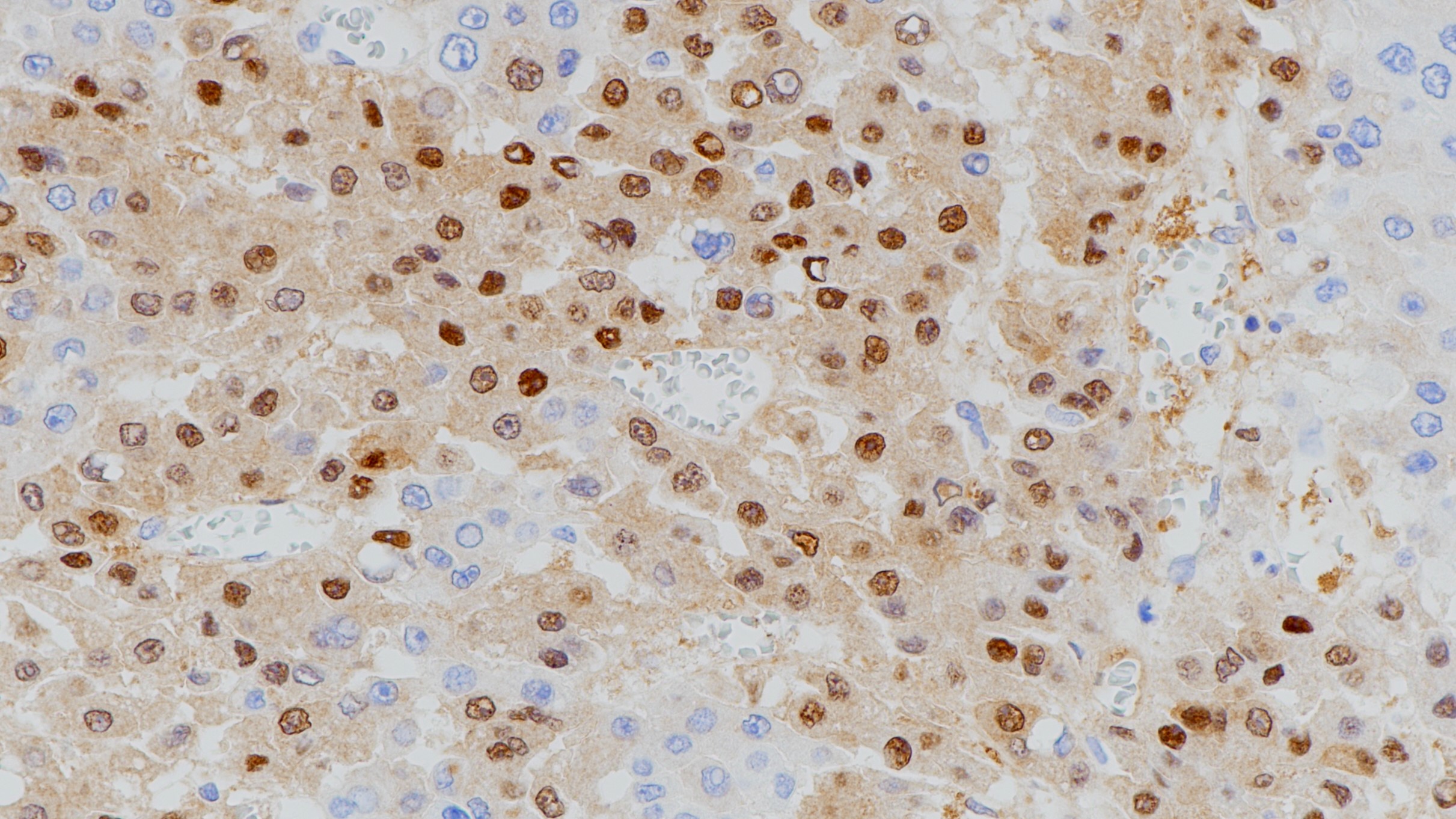 肝癌Arginase-1(EPR6672(B))染色