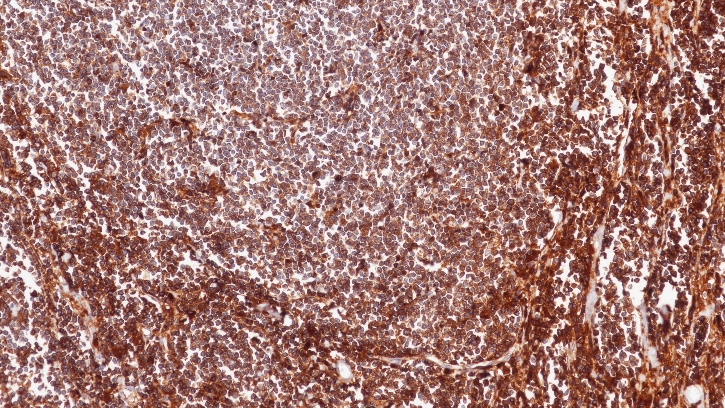 B细胞淋巴瘤Kappa(L1C1)染色