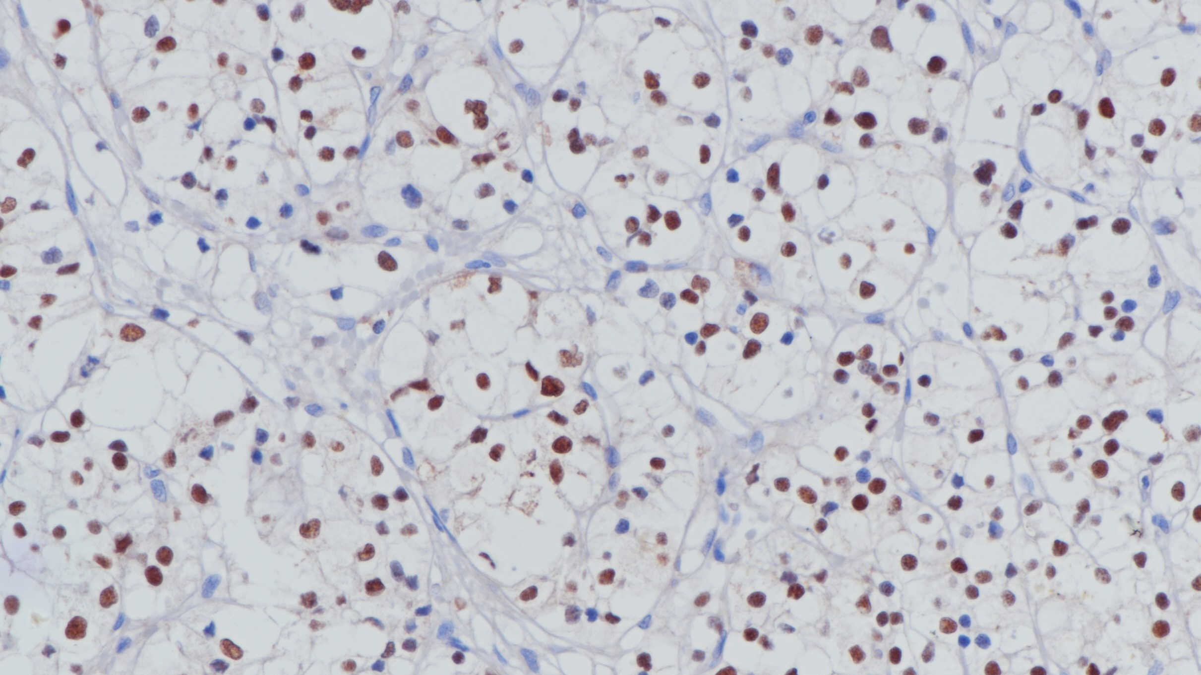 肾透明细胞癌Pax-8(BP6157)染色