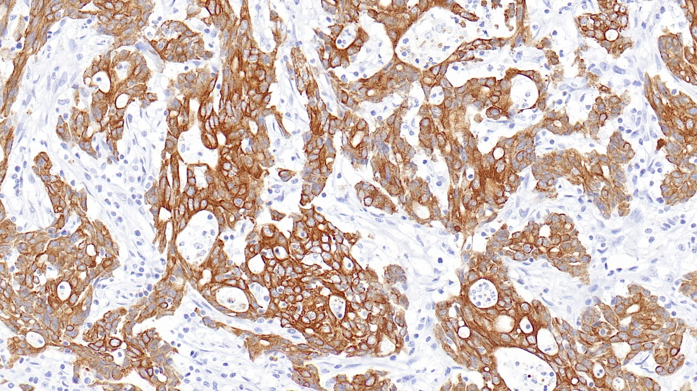 胃腺癌CAM 5.2(CAM 5.2)染色