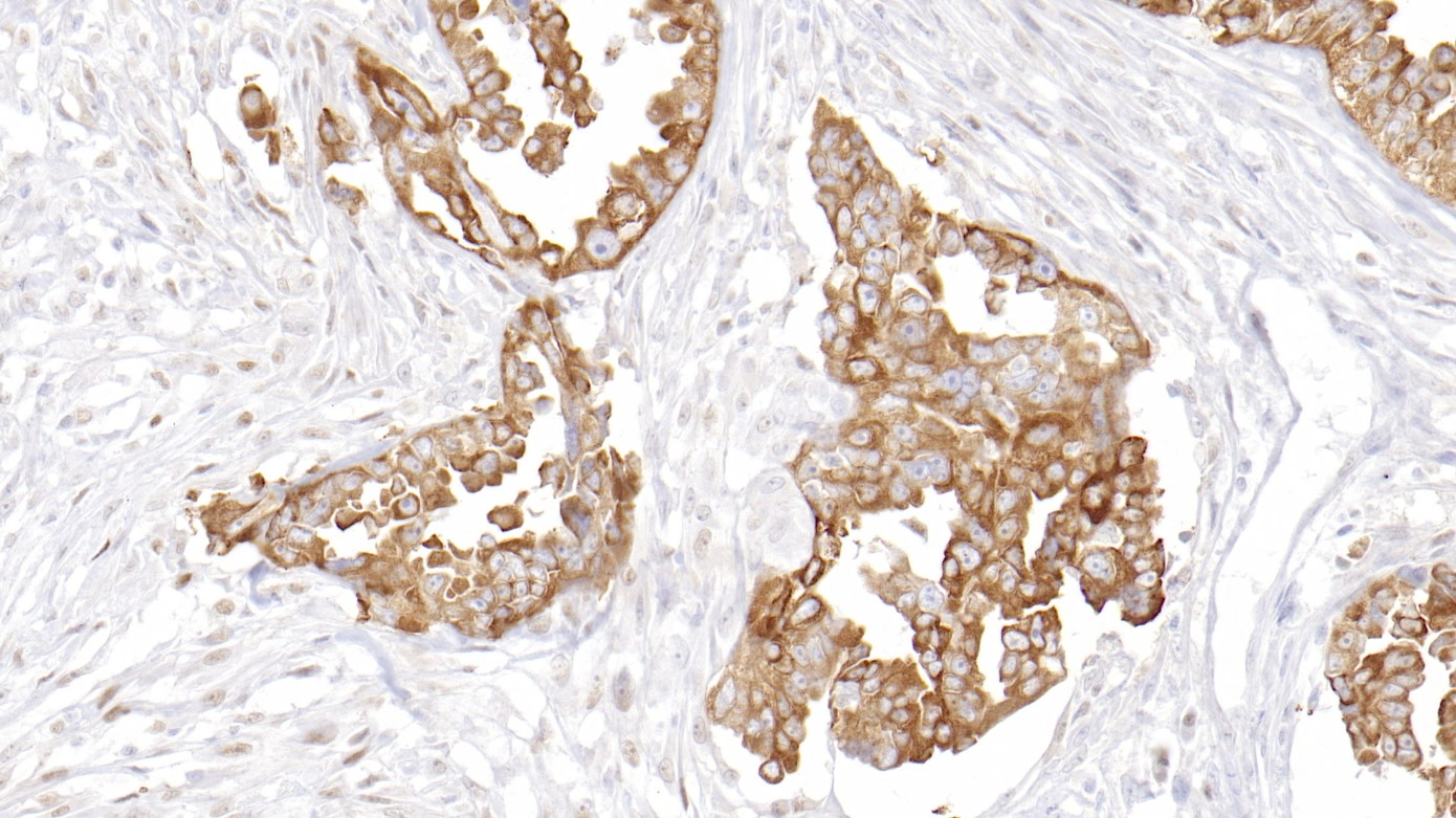 卵巢癌p62(EPR18351)染色