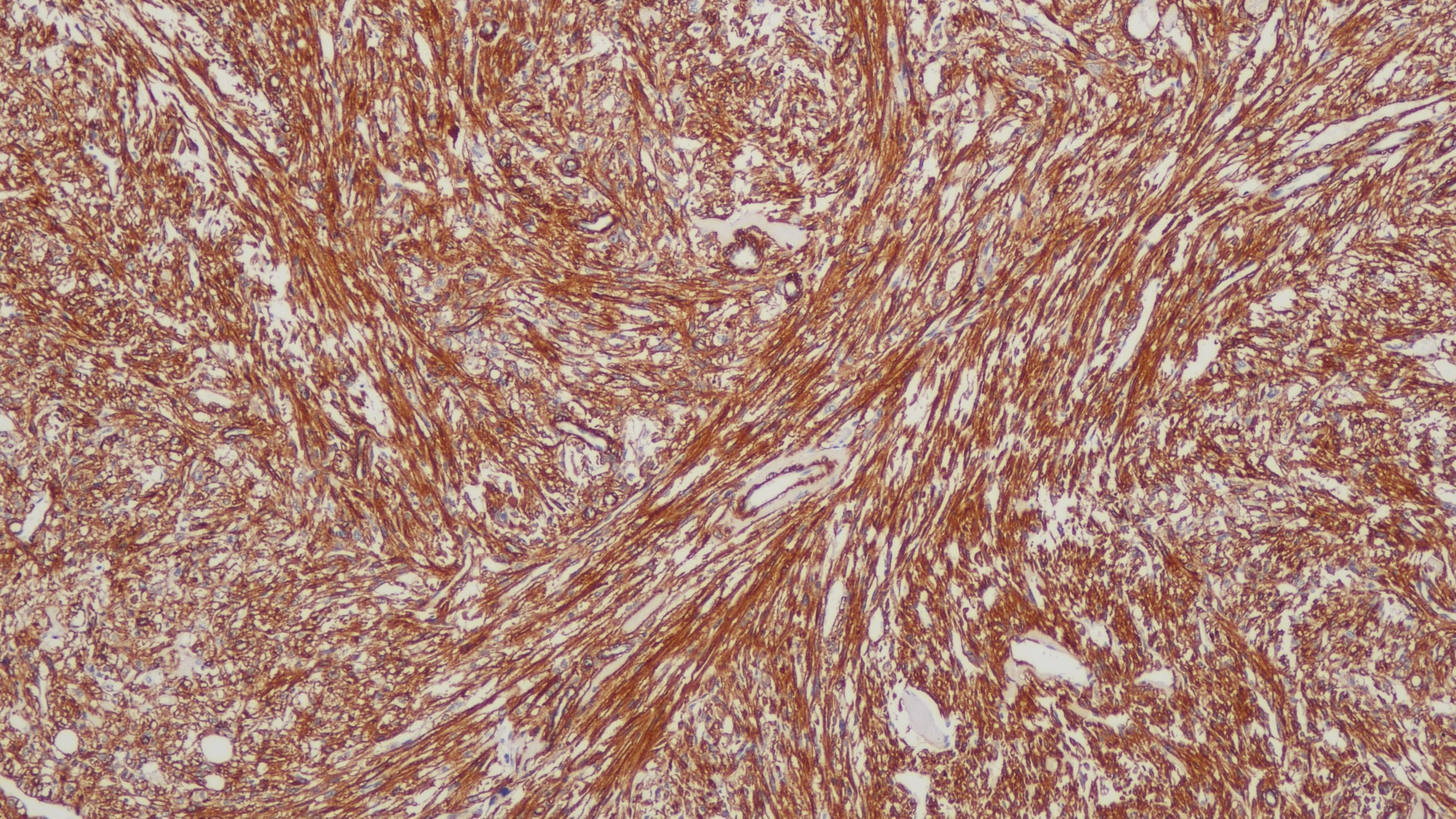 血管平滑肌瘤SMA(1A4)染色