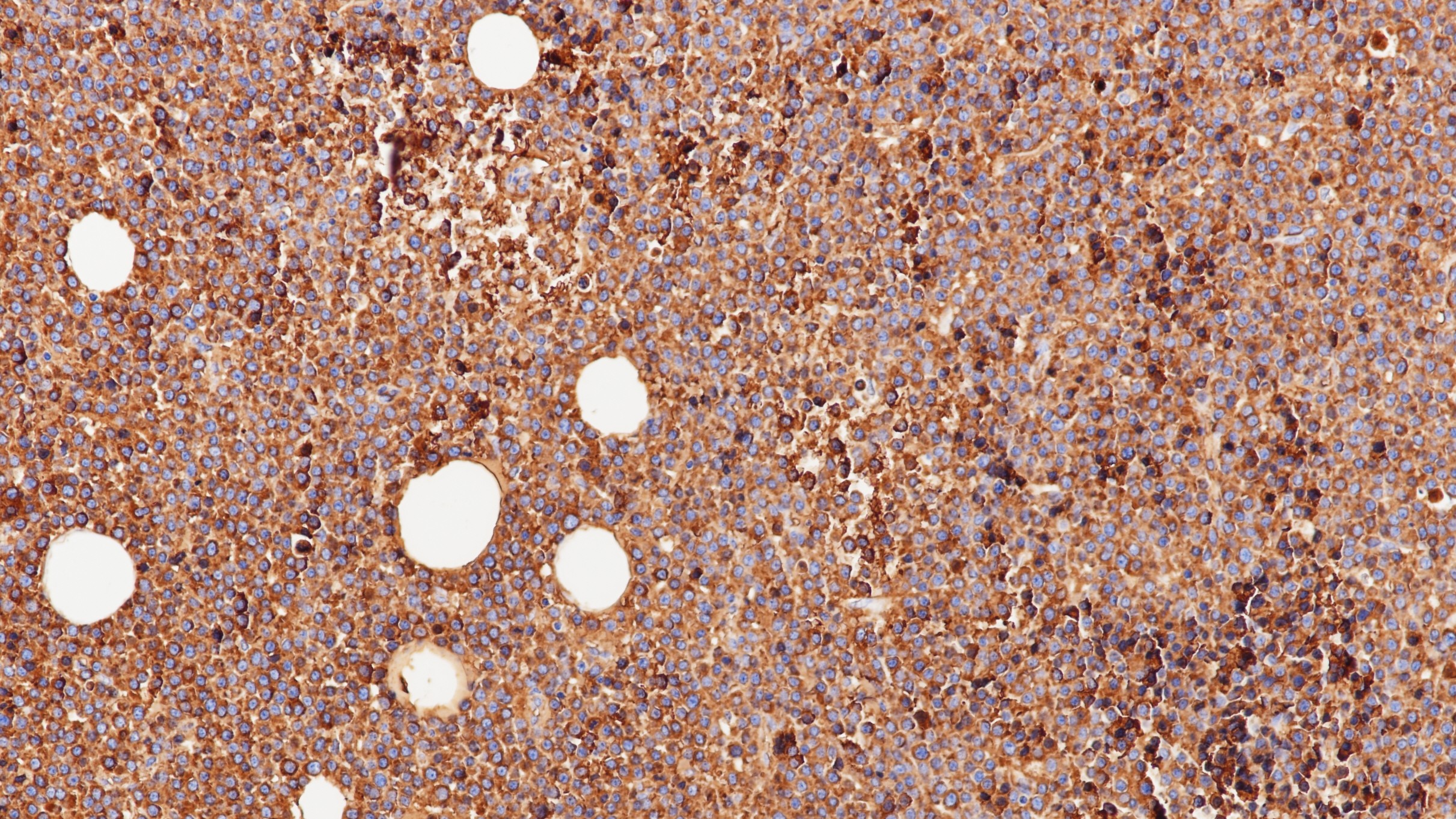 浆细胞瘤Lambda(BP6133)染色