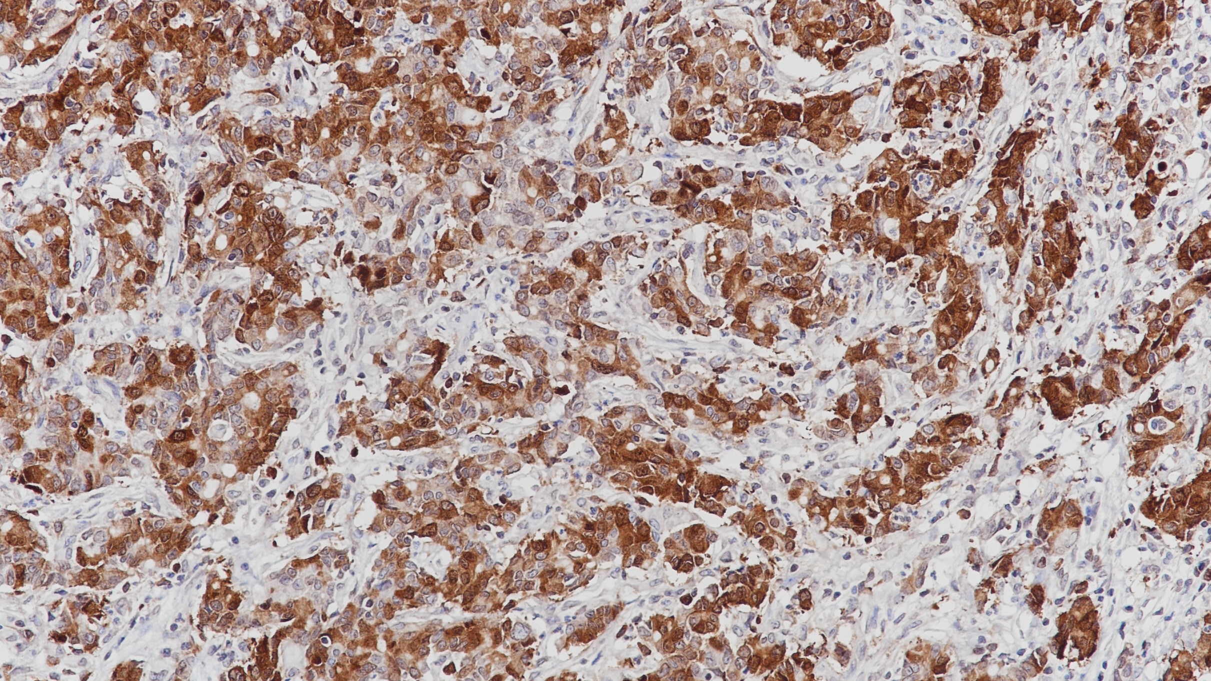 胃癌RRM1(BP6122)染色