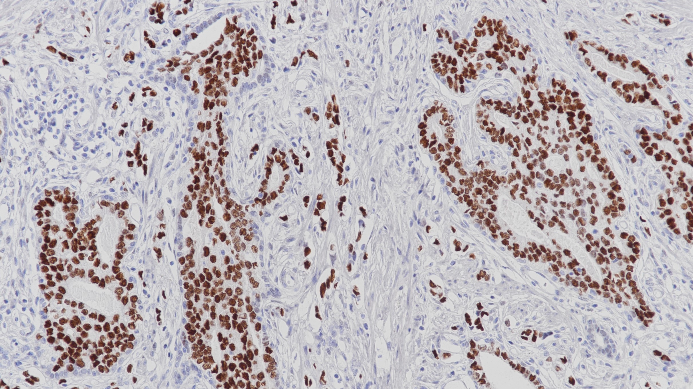 前列腺癌AR(BP6126)染色