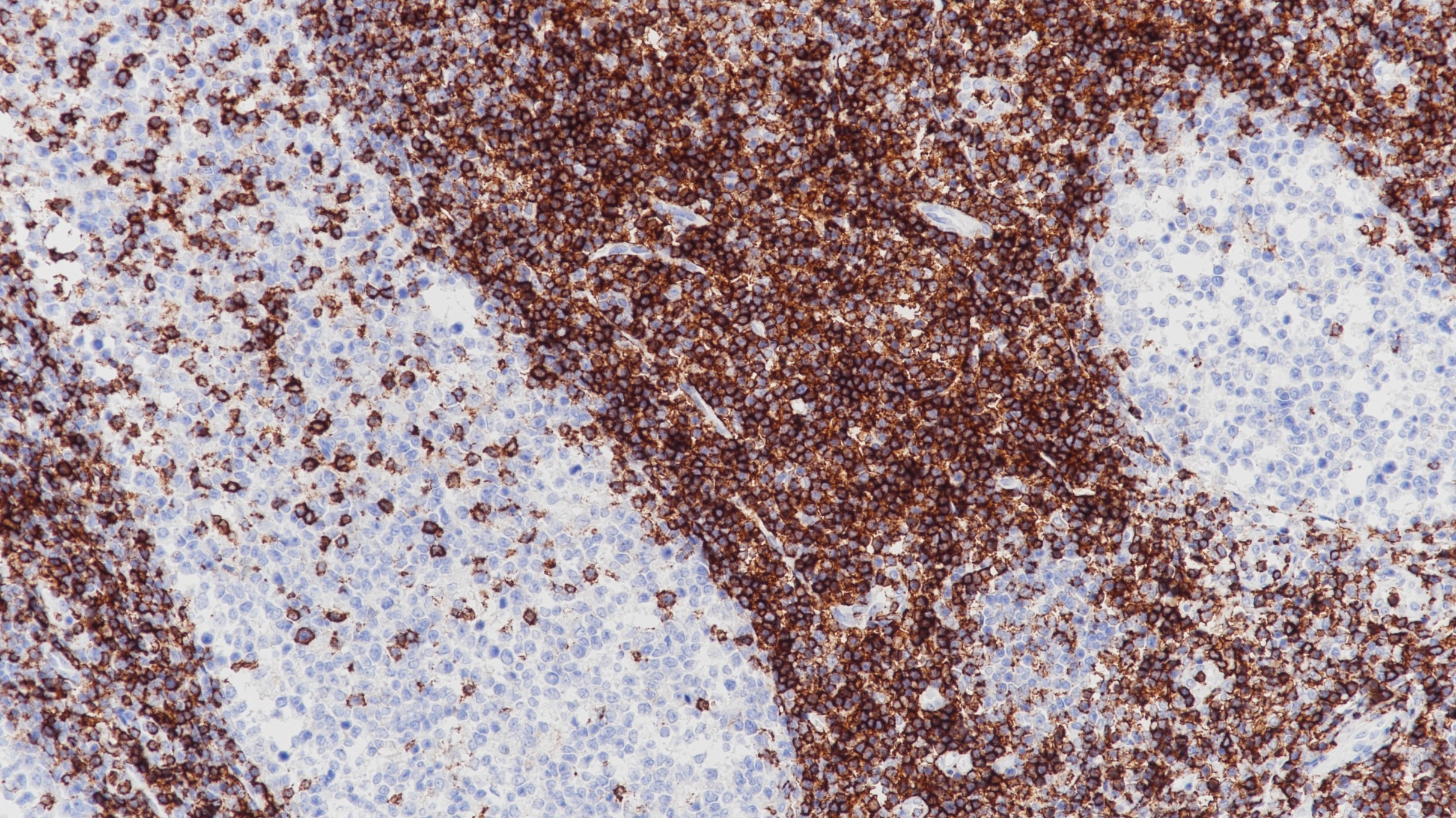 扁桃体CD43(DF-T1)染色