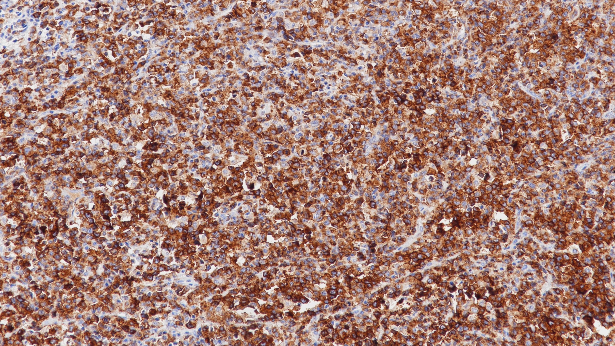渐变性大细胞淋巴瘤CD25(BP6120)染色