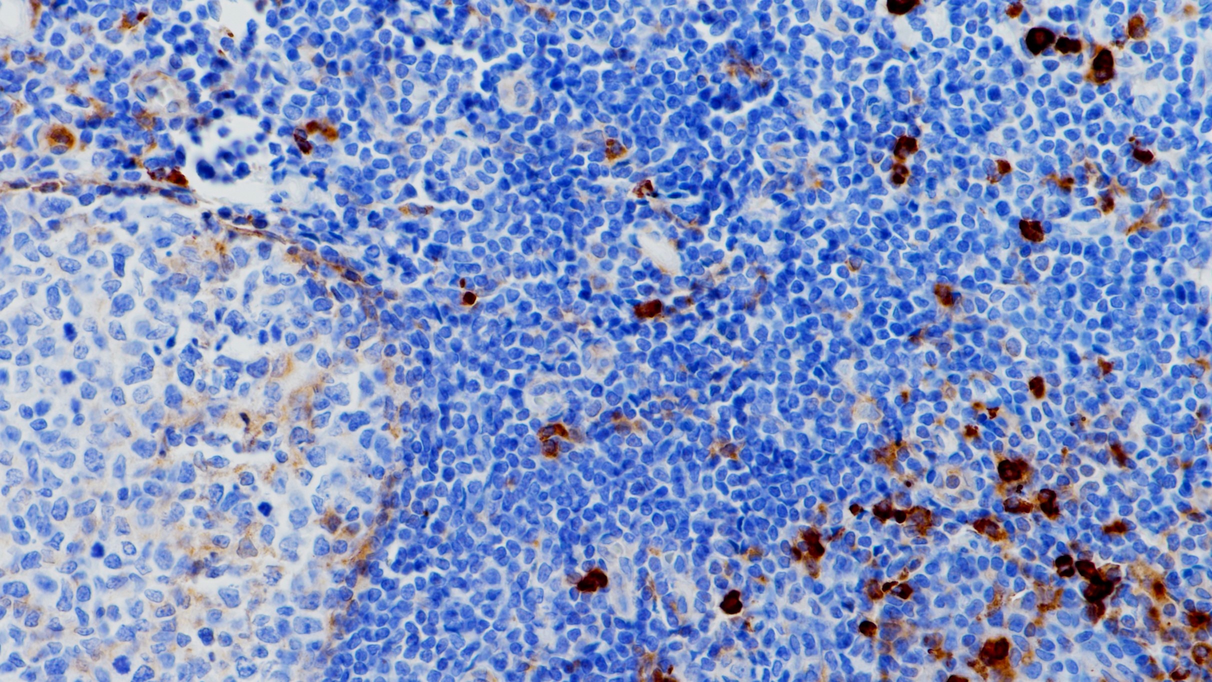 扁桃体CD14(BP6111)染色