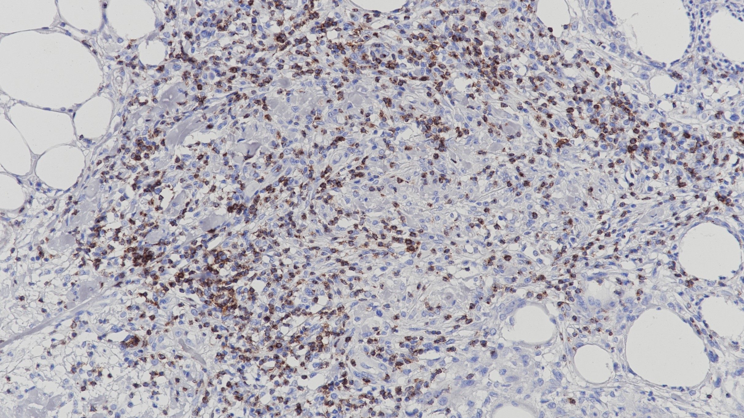 脂膜炎样T细胞淋巴瘤CD2(BP6107)染色
