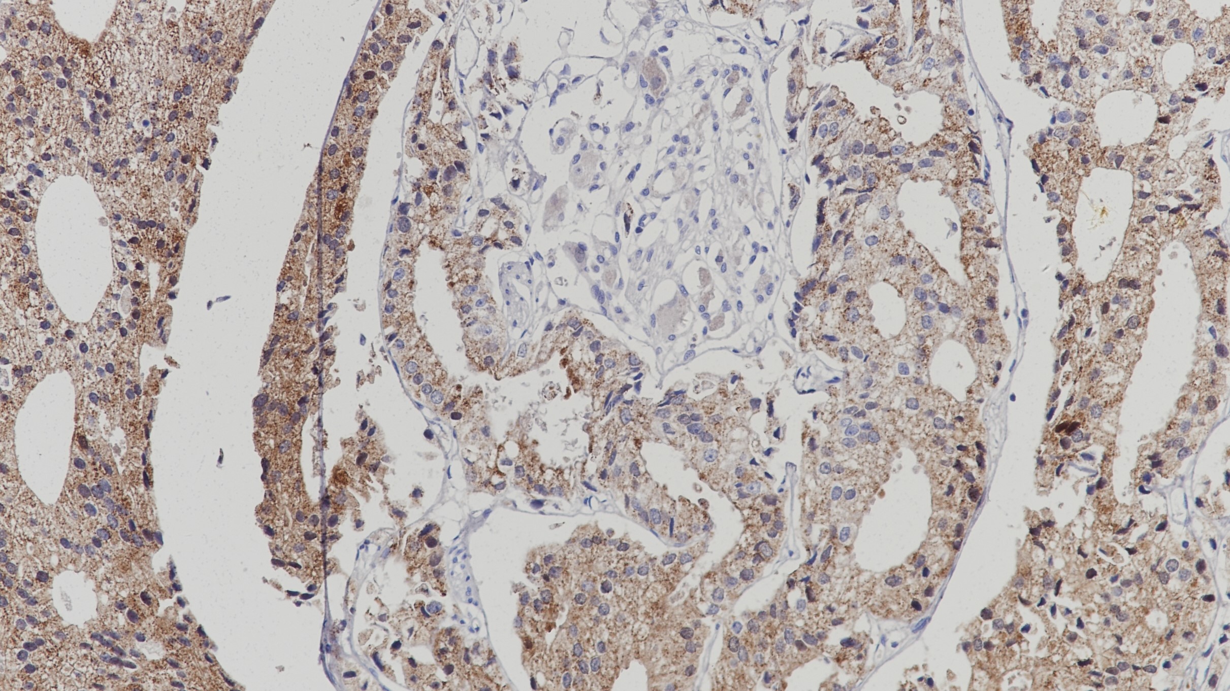 前列腺癌 AMACR(BP6115)染色