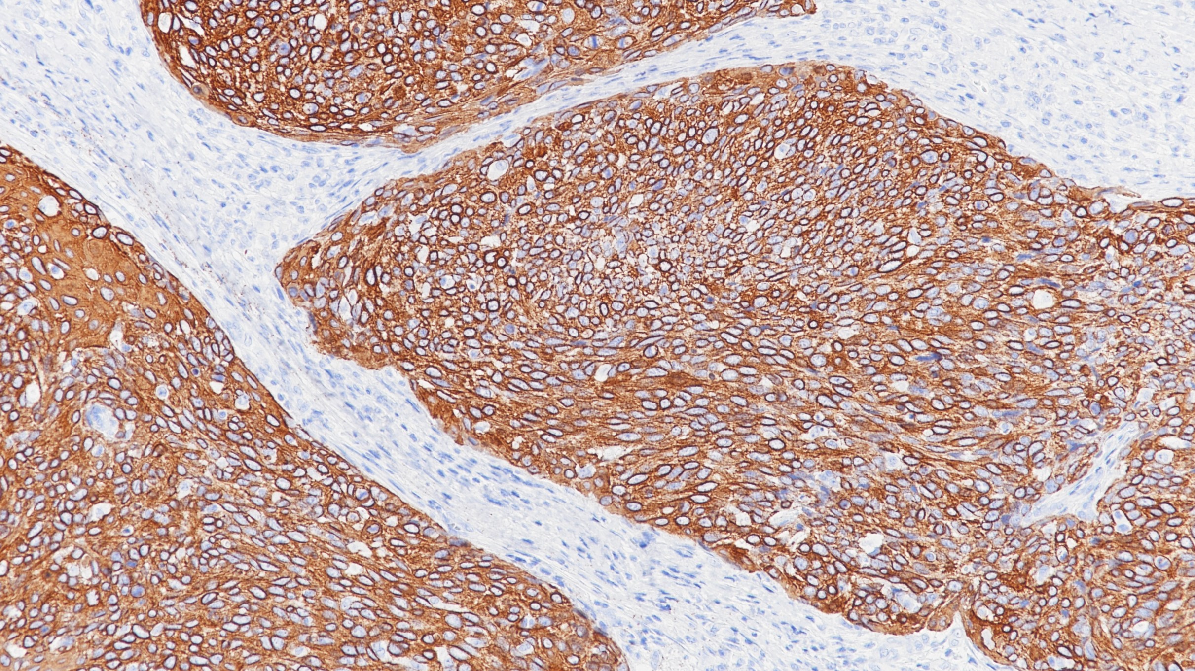 宫颈鳞癌CK6(BP6065)染色