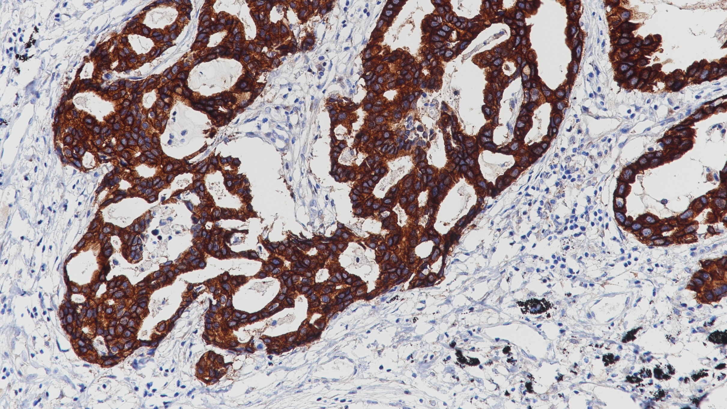 肺腺癌EGFR(BP6097)染色