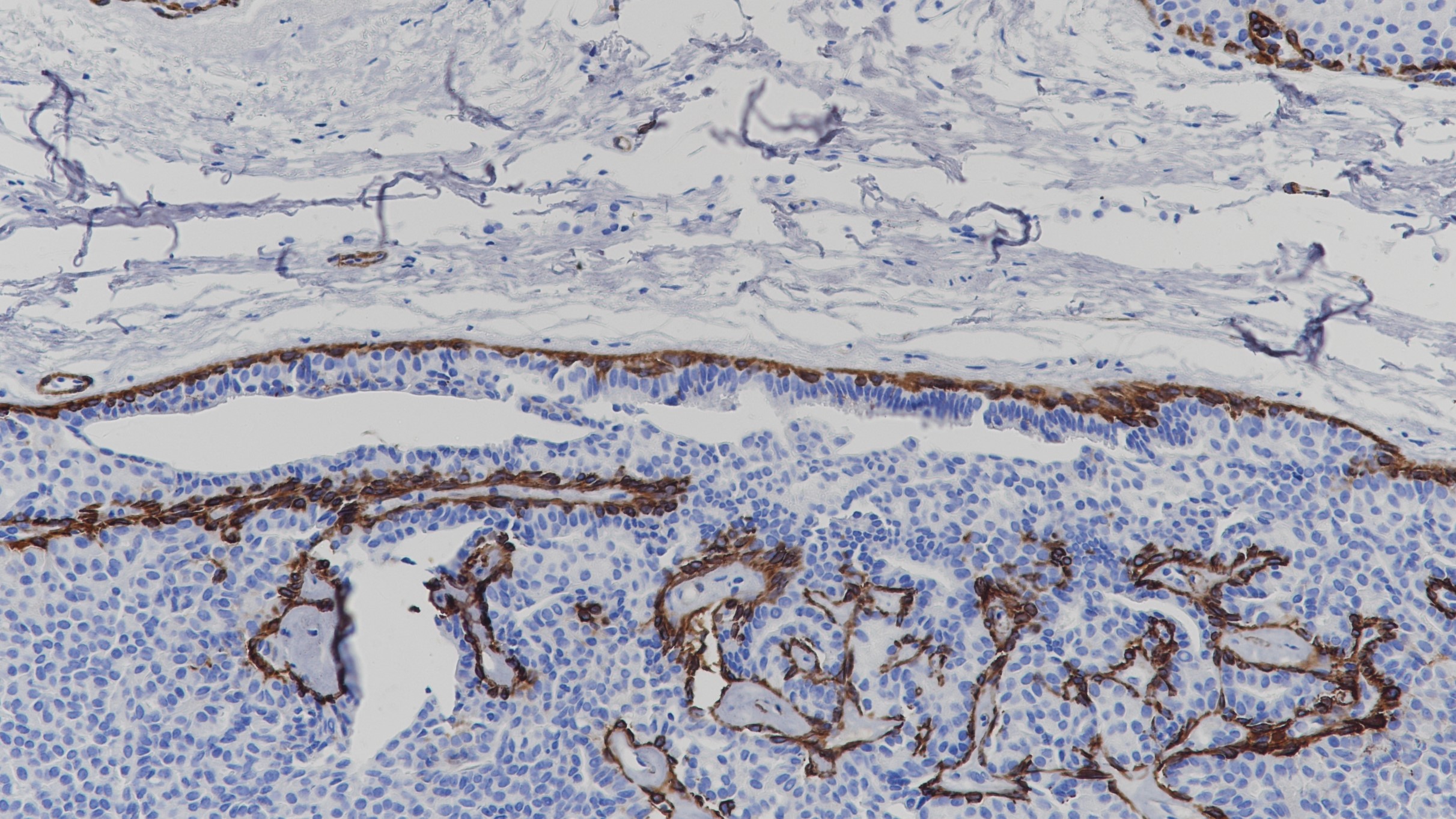 乳腺癌Myosin(Smooth Muscle)(BP6091)染色