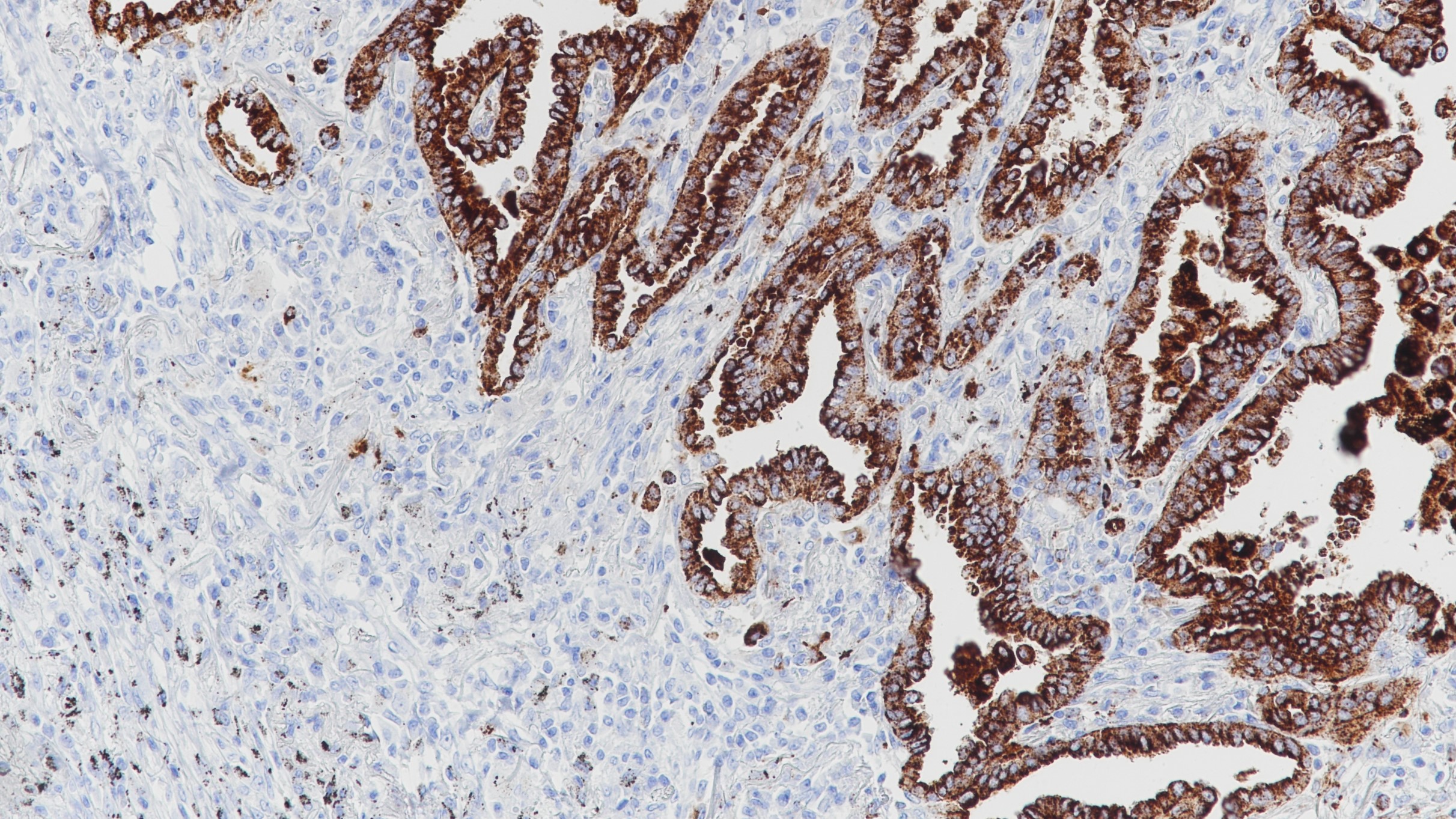 肺腺癌Napsin A (BP6083)染色