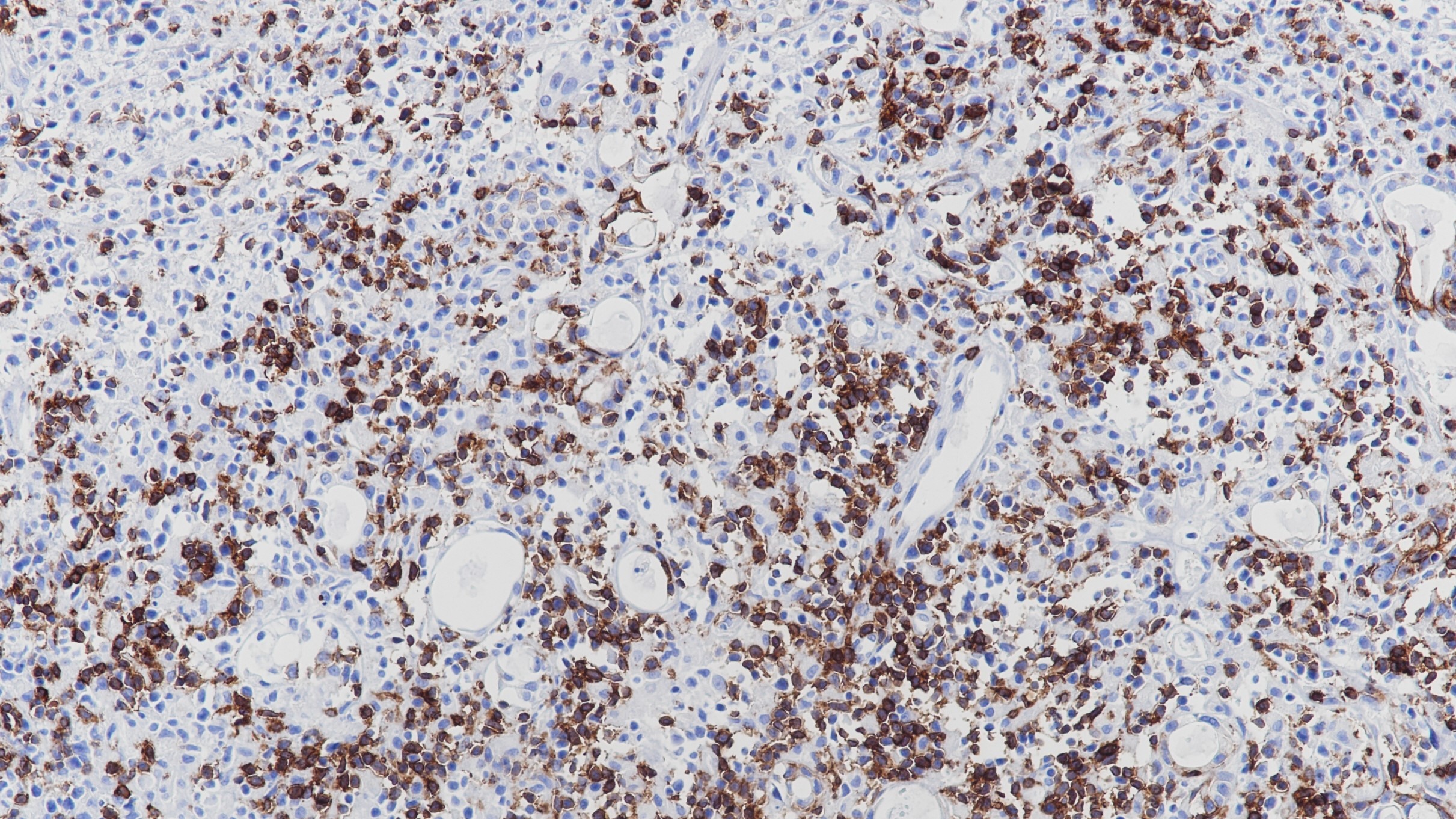 B细胞淋巴瘤CD5(BP6090)染色