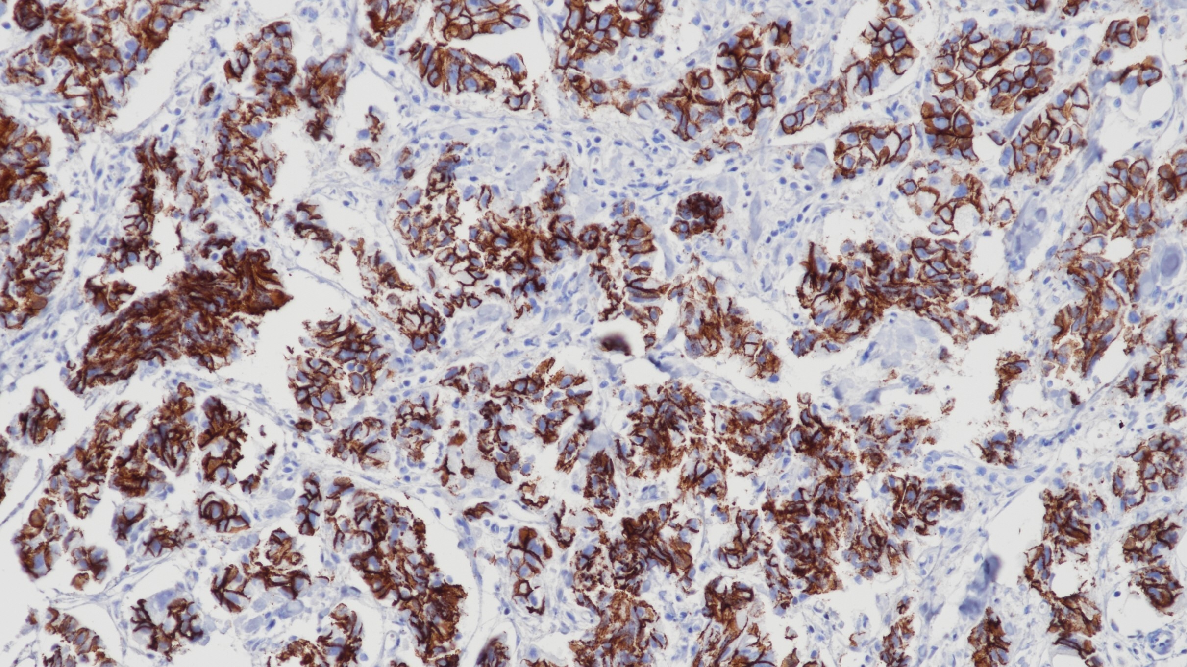 乳腺导管癌p120(BP6075)染色