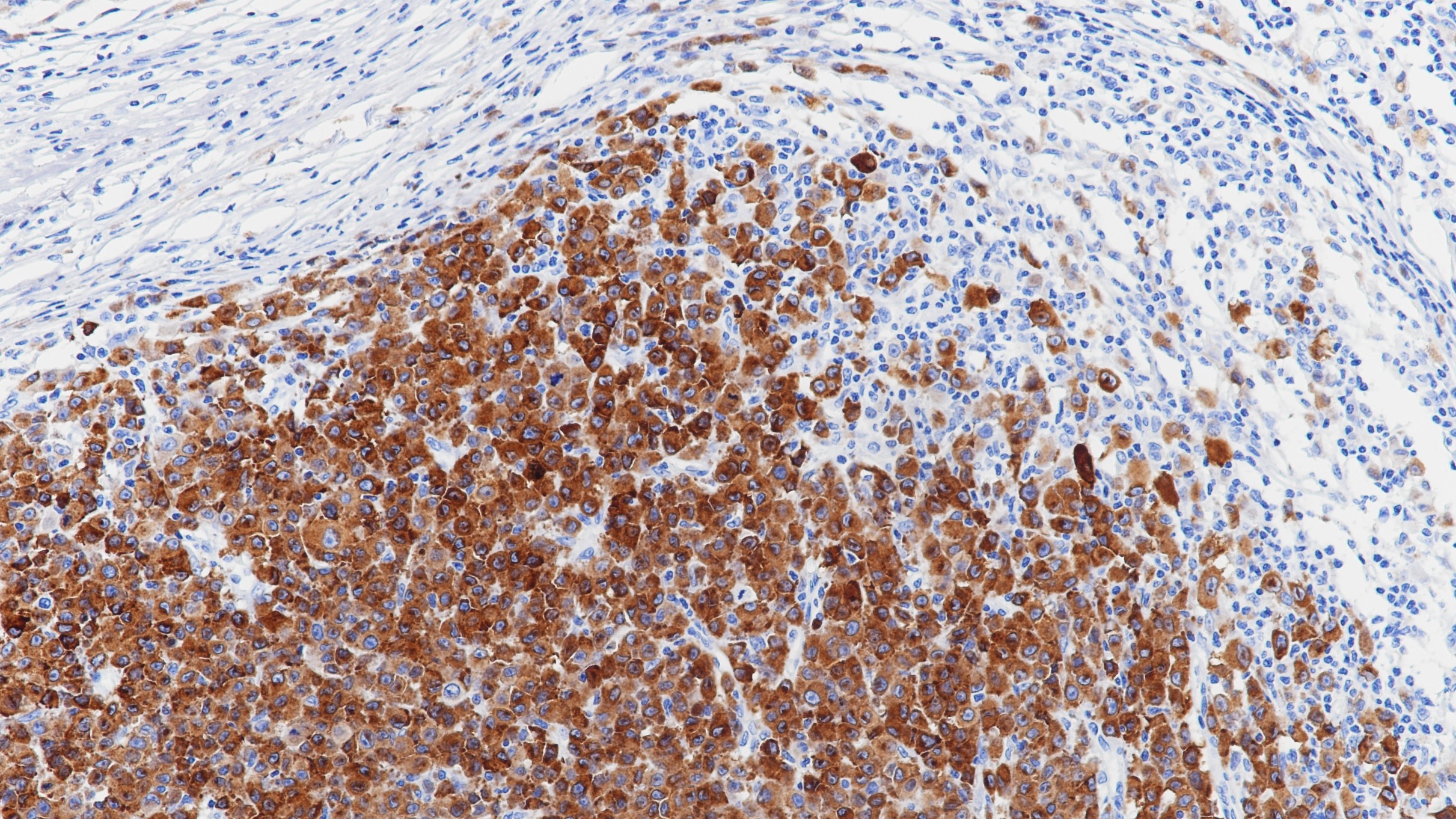恶性黑色素瘤Melan-A(BP6086)染色