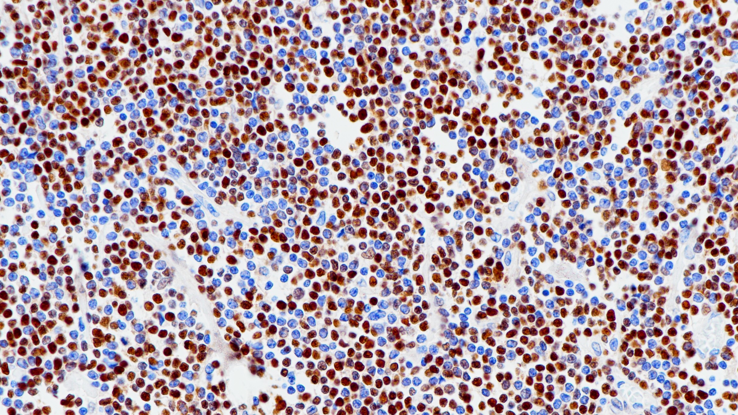 套细胞淋巴瘤Cyclin D1 (BP6076)染色