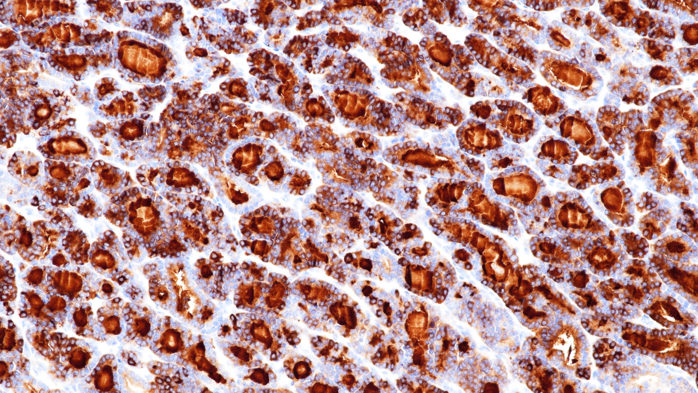 甲状腺滤泡癌THY(BP6067)染色