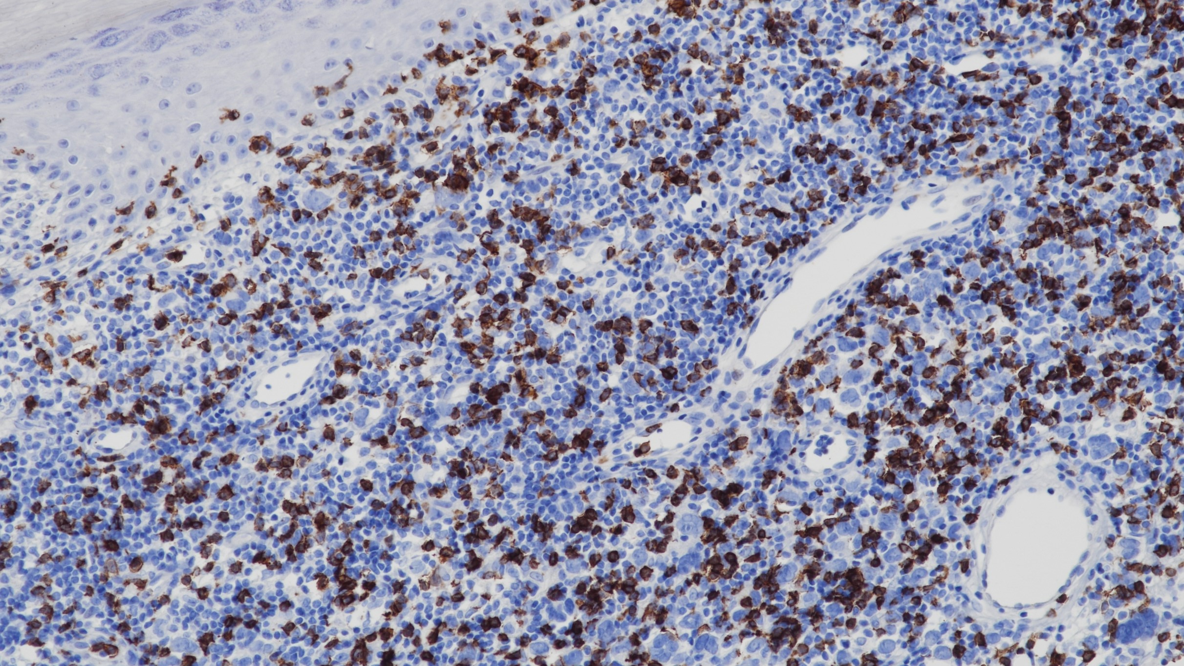 细胞淋巴瘤CD8(BP6041)染色