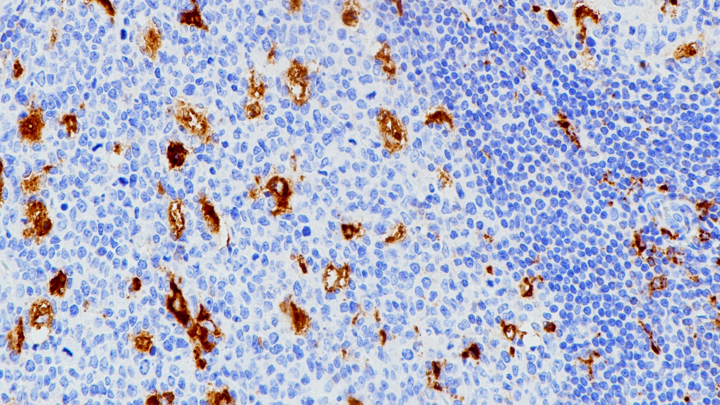 扁桃体CD68(BP6036)染色