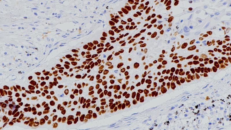肺鳞癌p40(bp6033)染色