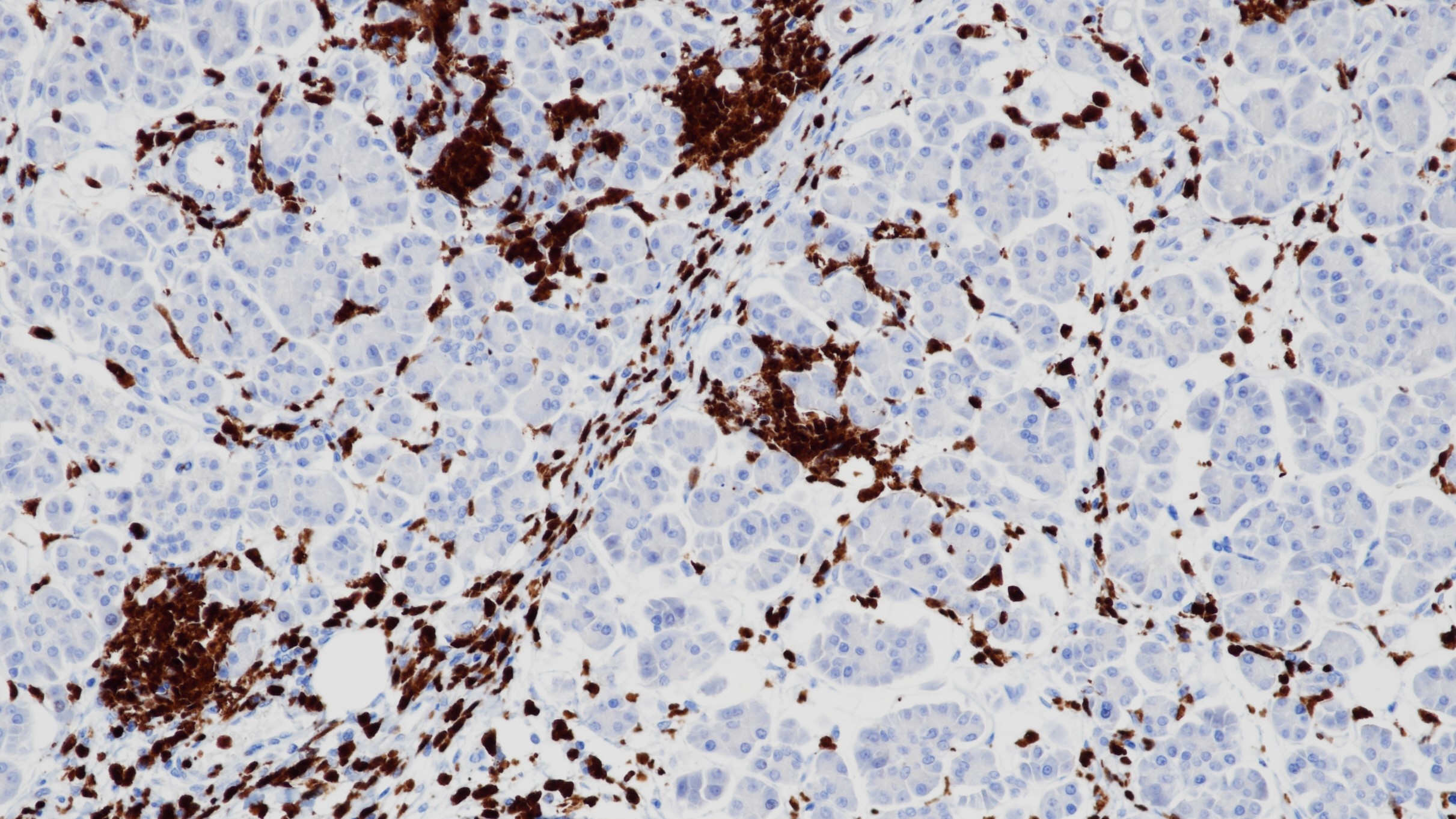 胰腺S100P(BP6018)染色