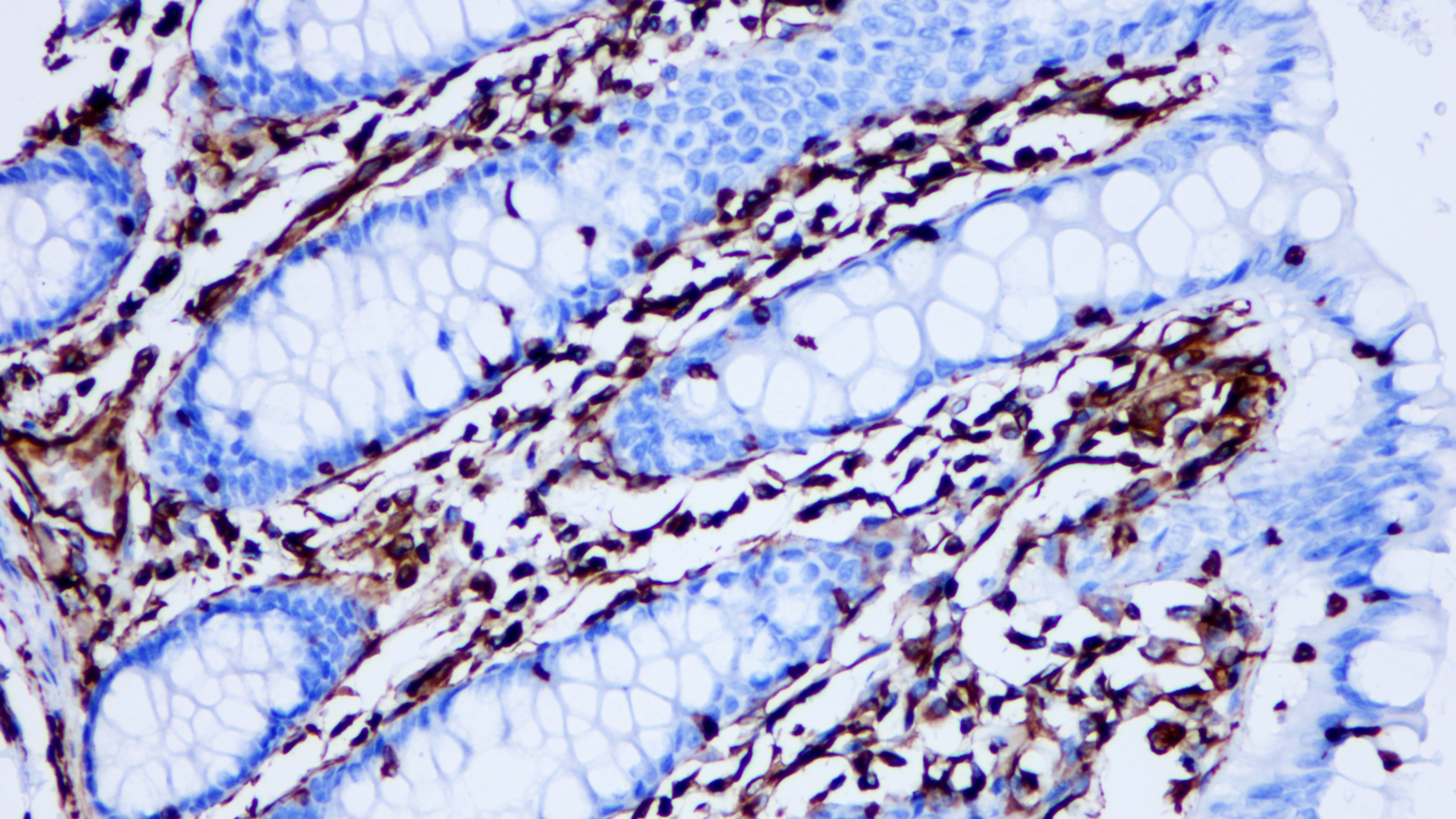 结肠Vimentin(BP6010)染色