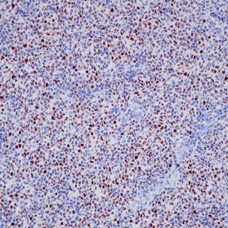 滤泡性淋巴瘤Bcl-6(BP6216)染色