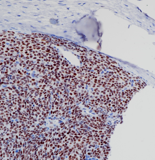 滑膜肉瘤TLE1(BP6223)染色