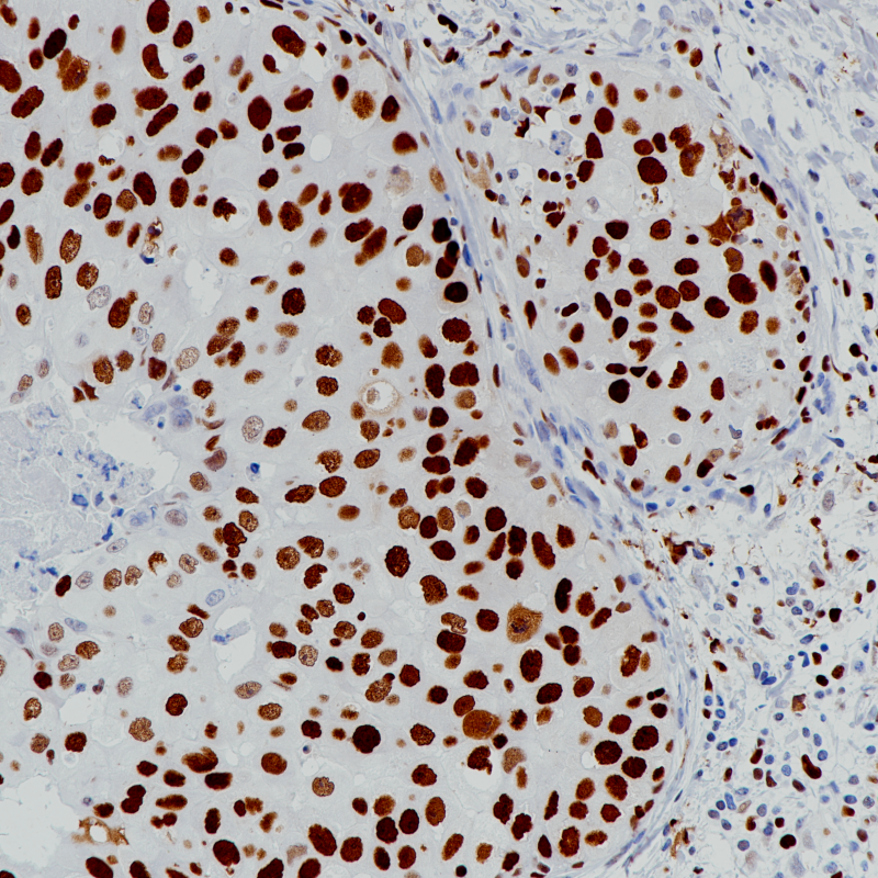 乳腺癌MCM2(BP6220)染色