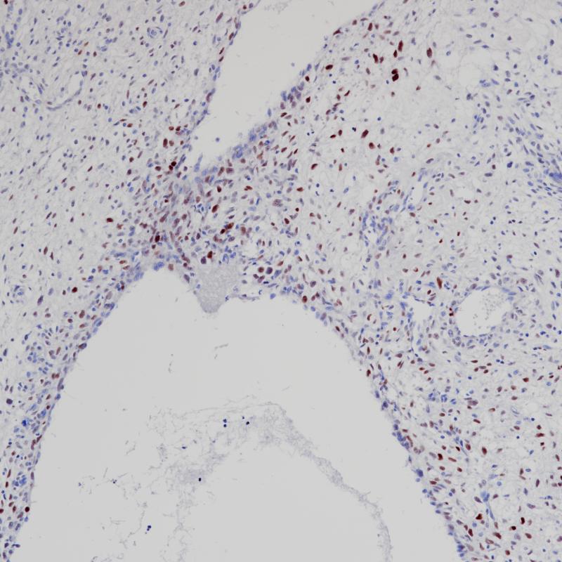 去分化脂肪肉瘤MDM2(BP6203)染色