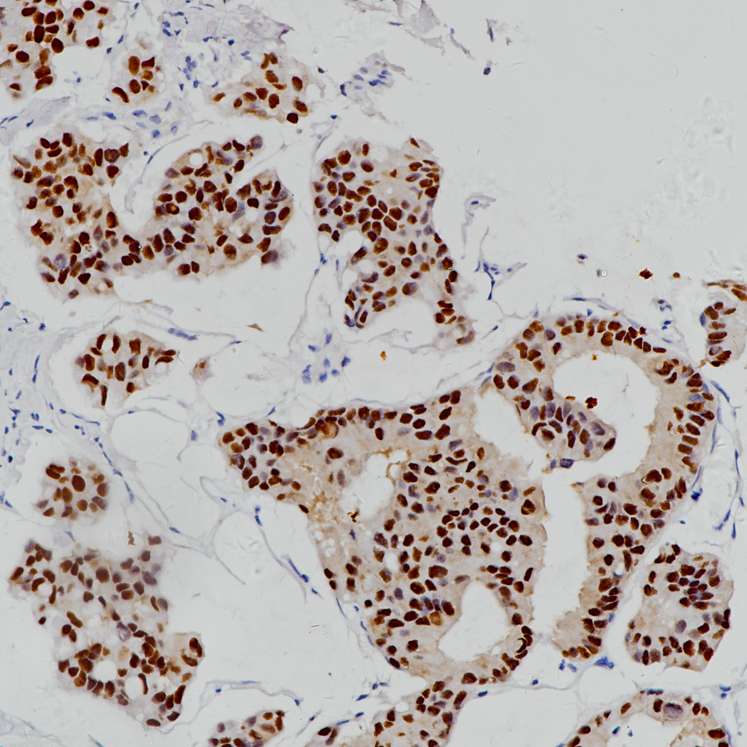 乳腺癌GATA3(EP368)染色