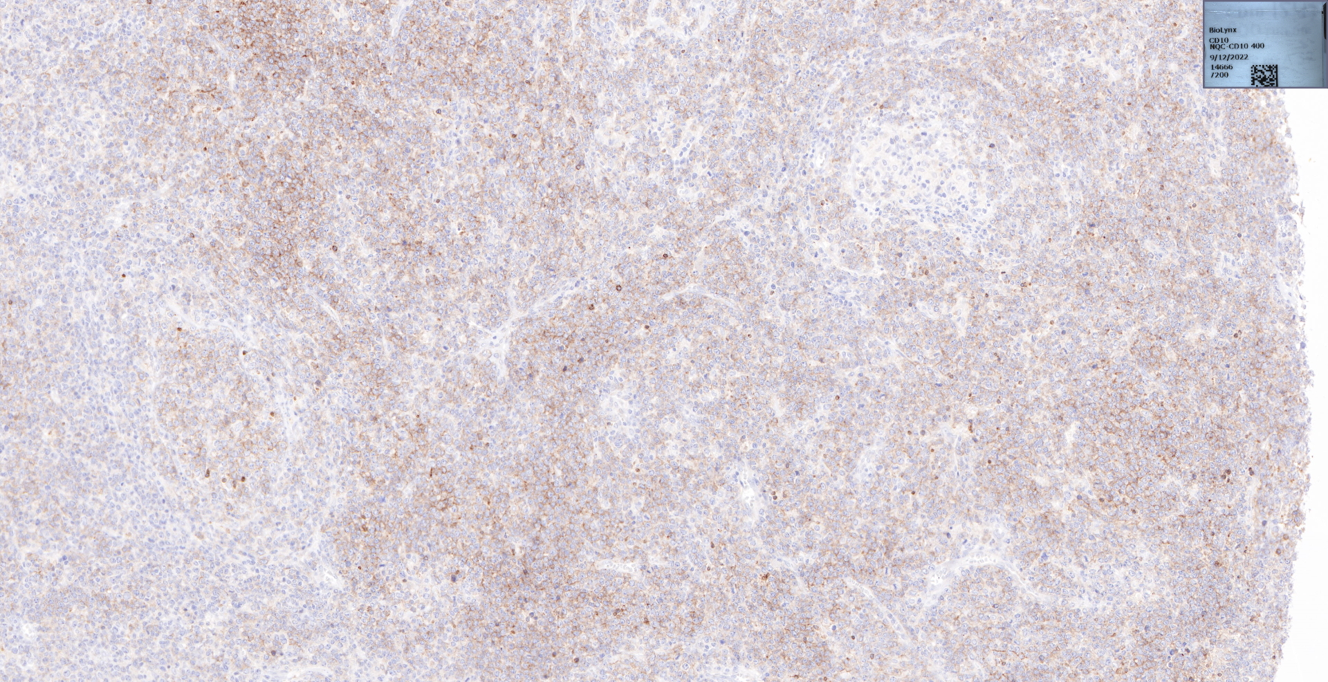 弥漫大B细胞淋巴瘤（GCB）.jpg