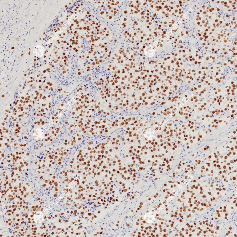 精原细胞瘤SALL4（BP6245）染色